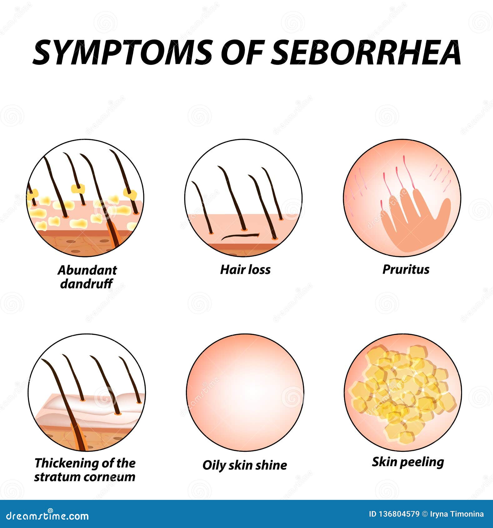 Symptoms of Seborrhea. Seborrhea Skin and Hair. Dandruff, Seborrheic  Dermatitis Stock Vector - Illustration of loss, illness: 136804579
