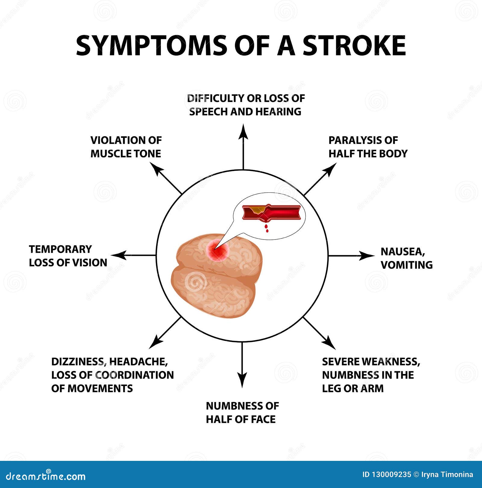 Symptoms Of A Stroke. World Stroke Day. Infographics. Vector