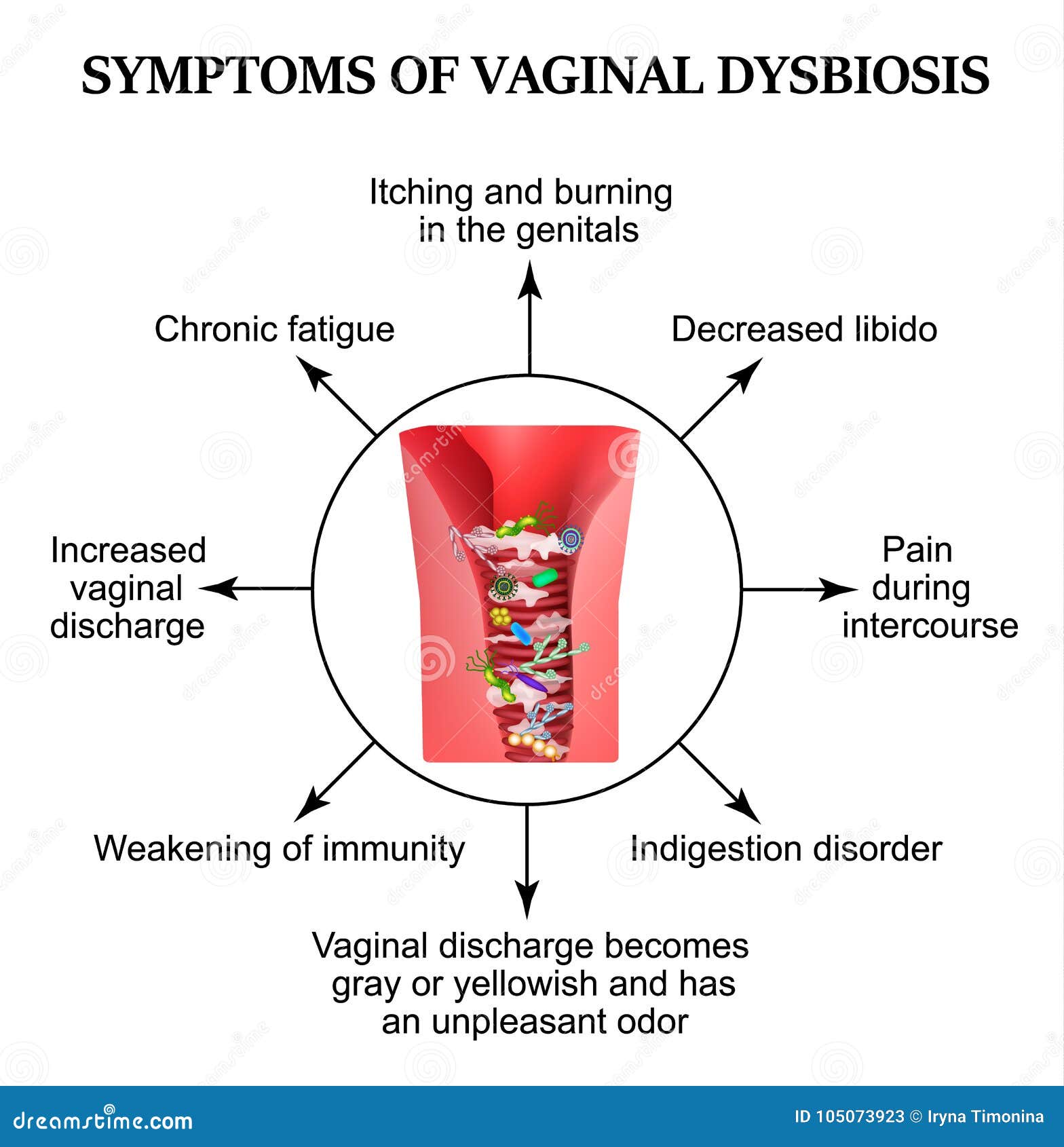 symptoms of vaginal dysbiosis. vaginitis, candidiasis. patagene microflora of the vagina. dysbacteriosis. infographics.