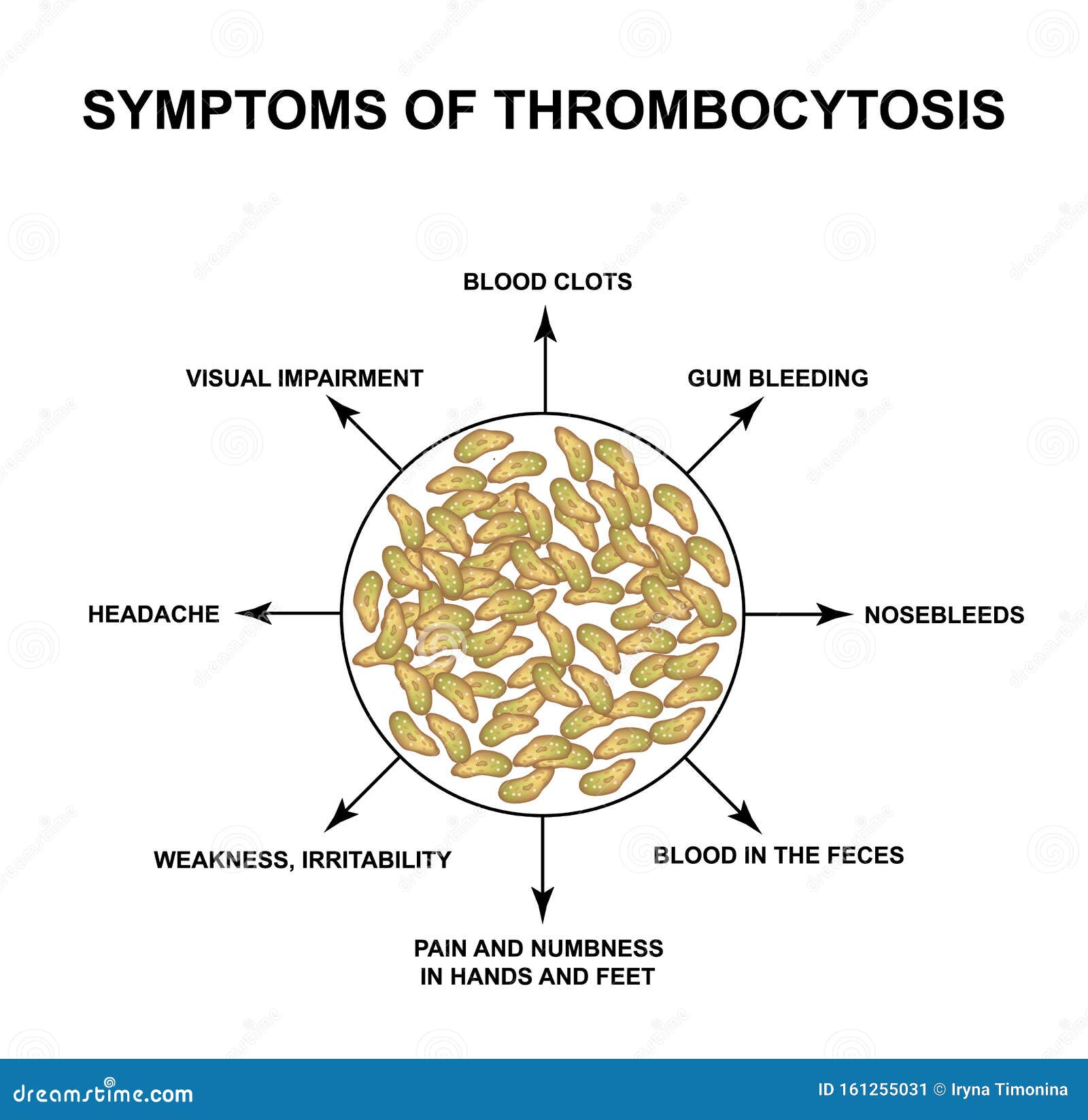 Symptômes De Thrombocytose Augmentation Des Plaquettes Dans Le Sang