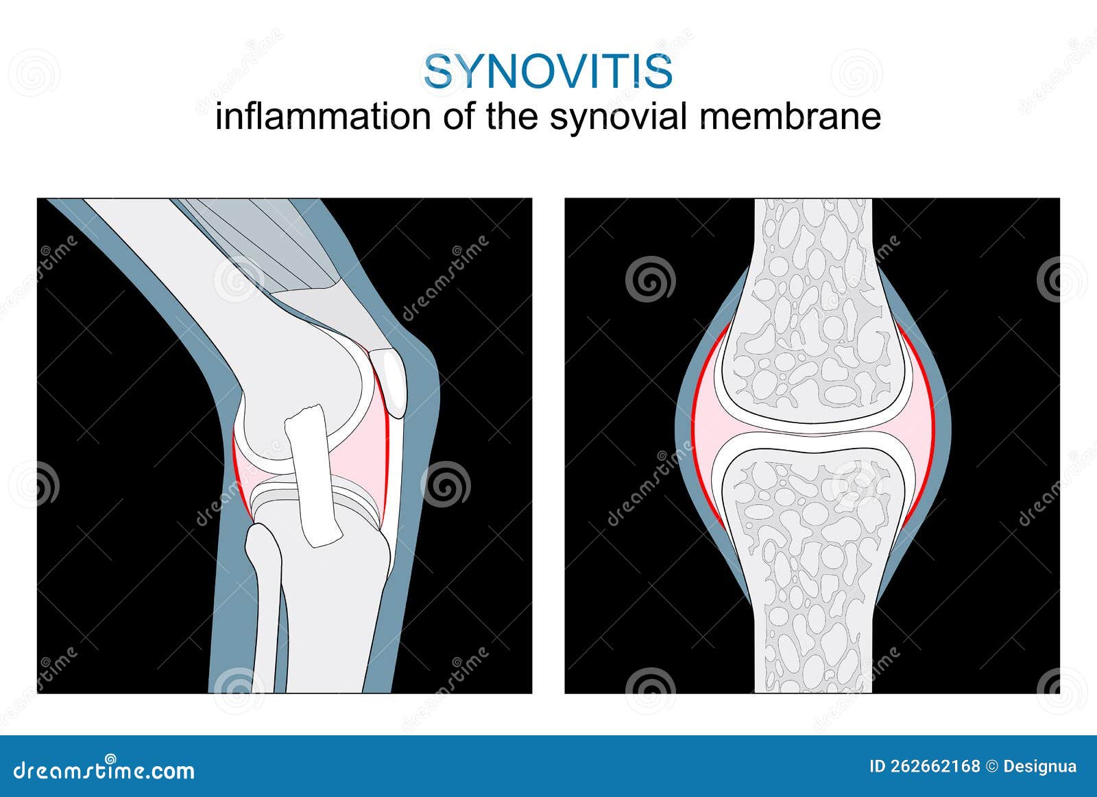 synovitis. inflammation of the synovial membrane. knee and synovial joint