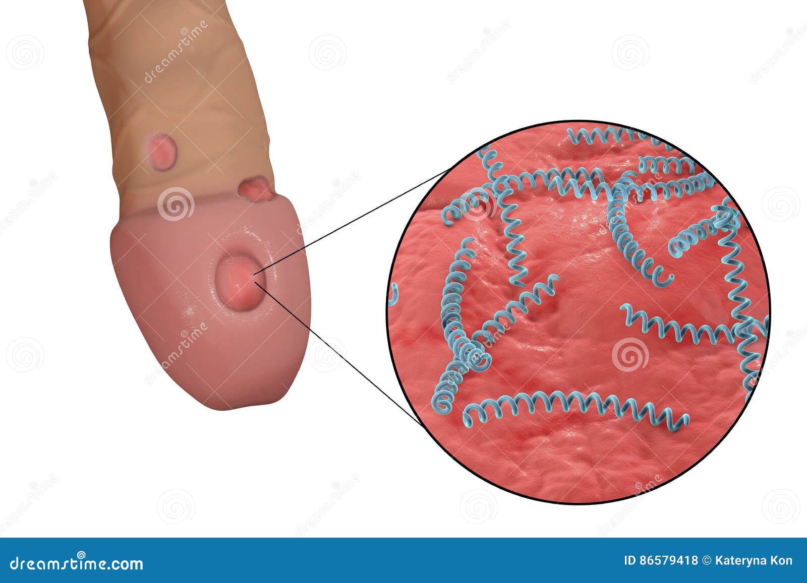 Syphilitic Ulcer And Bacteria Treponema Pallidum Stock Illustration - Illus...