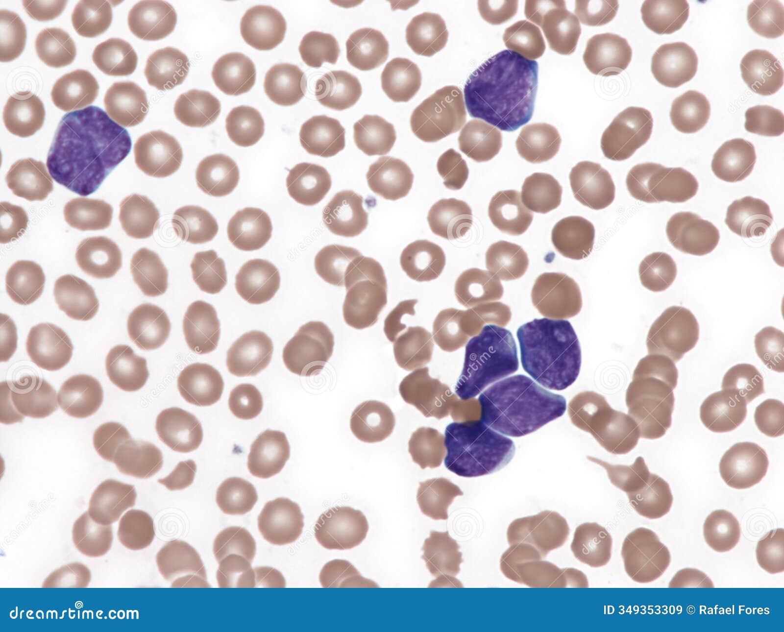 t-cell acute lymphoid leukemia. peripheral blood.