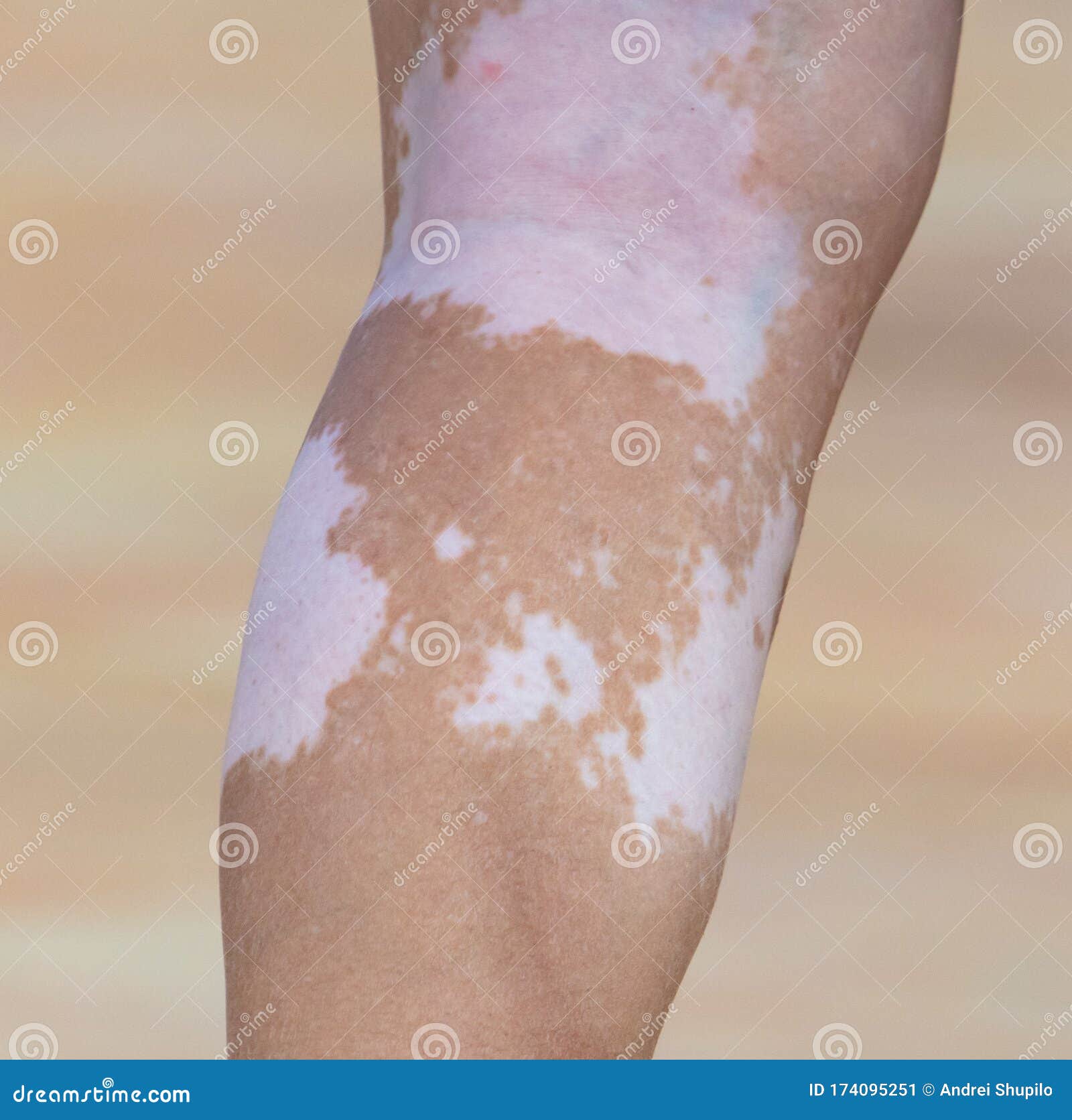 Taches Blanches Sur Le Pied Image stock - Image du beauté, jeune ...