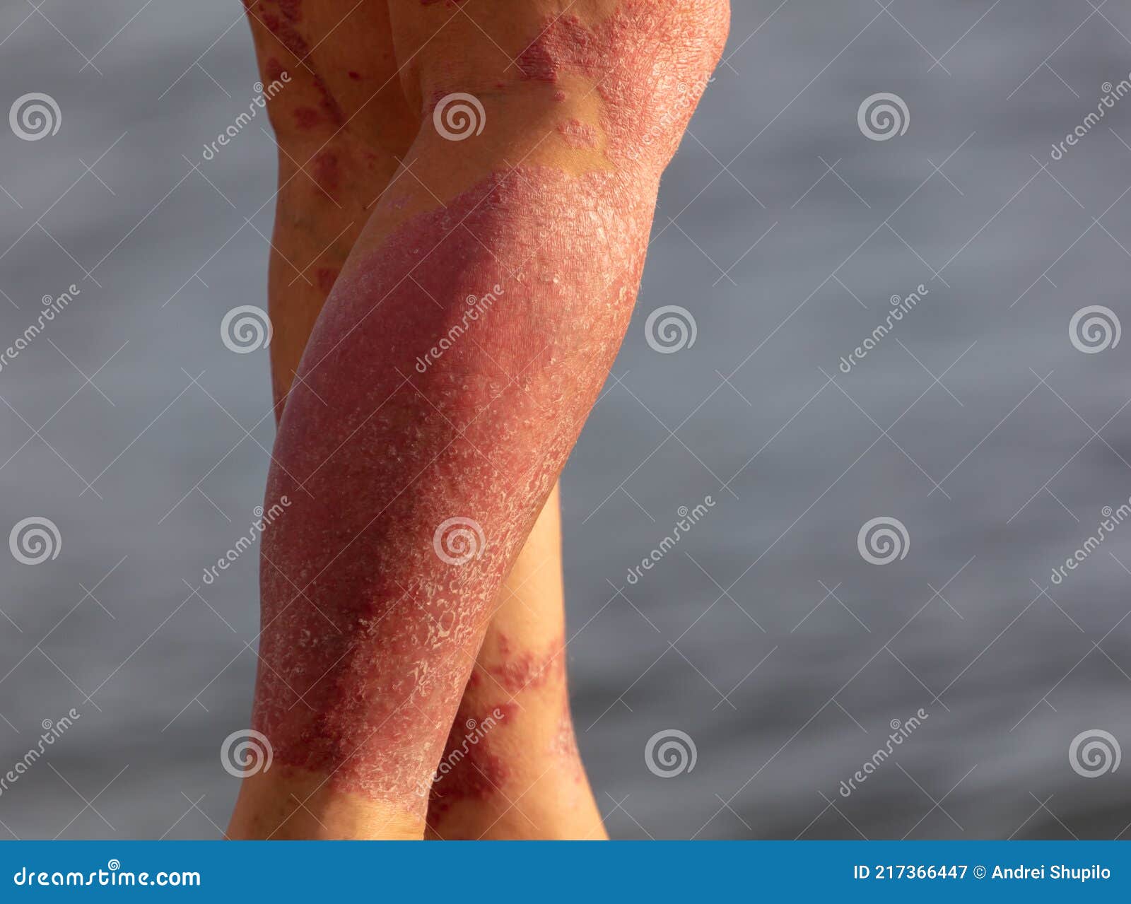 Taches Rouges Sur Les Jambes D'une Personne. Image stock - Image ...