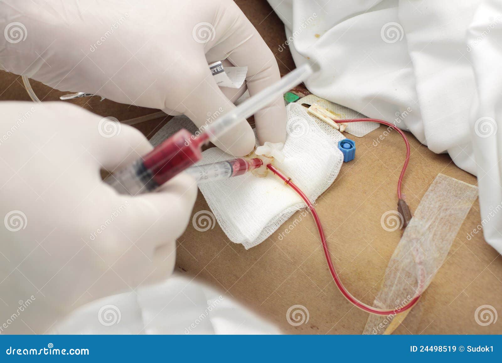 Taking an Arterial Blood Sample Stock Image Image of person, arteries