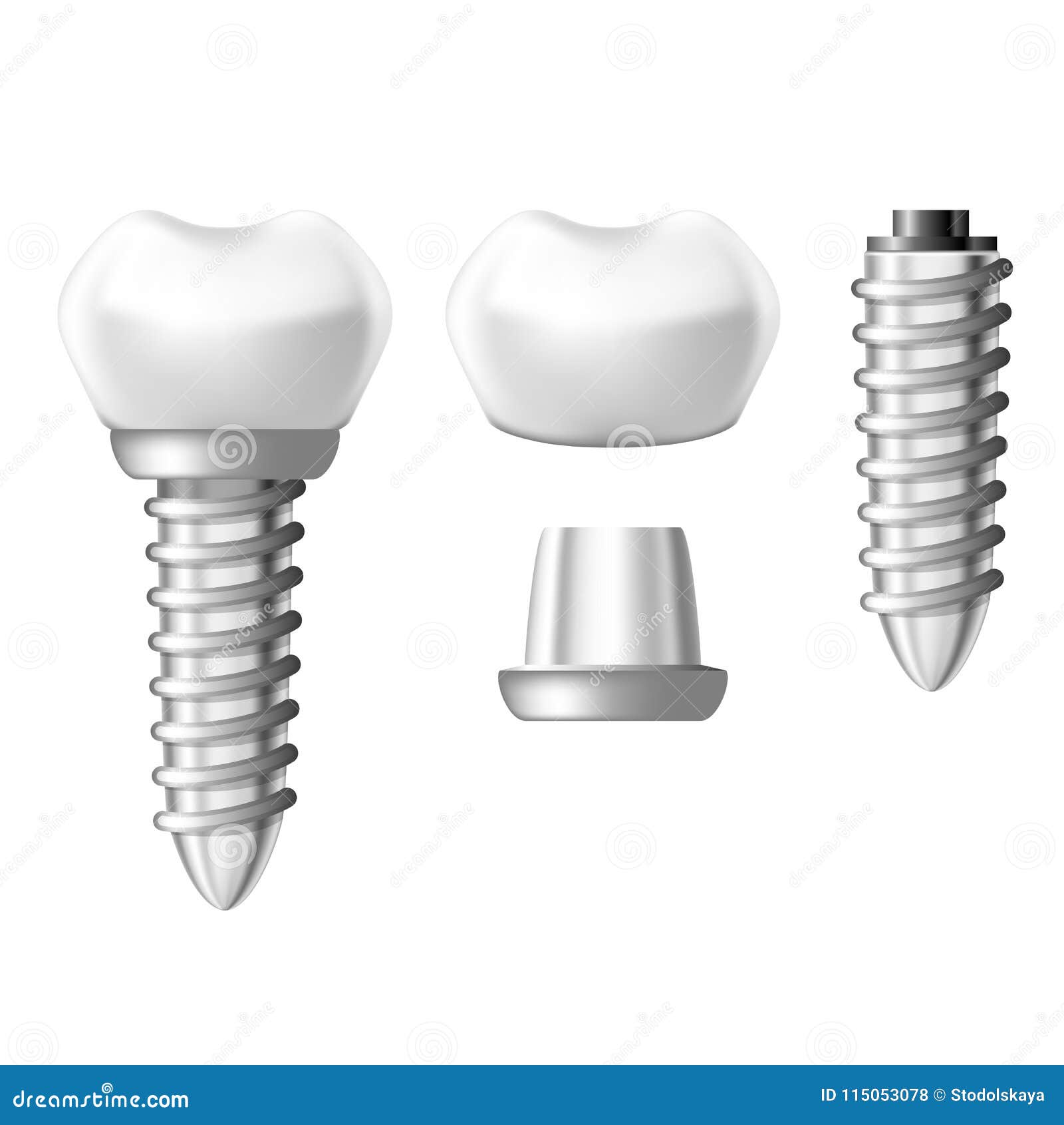 Tandimplant Onderdelen - De Componenten Het Tandgebit Illustratie Illustration of deel, inplanting: 115053078