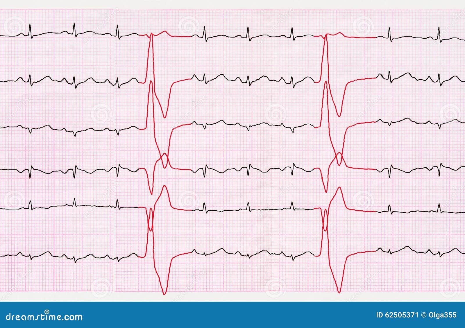 Ventricular Quadrigeminy
