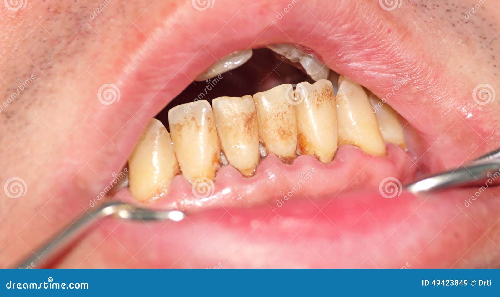 Tartar and Plaque on Frontal Teeth Stock Image Image of tooth