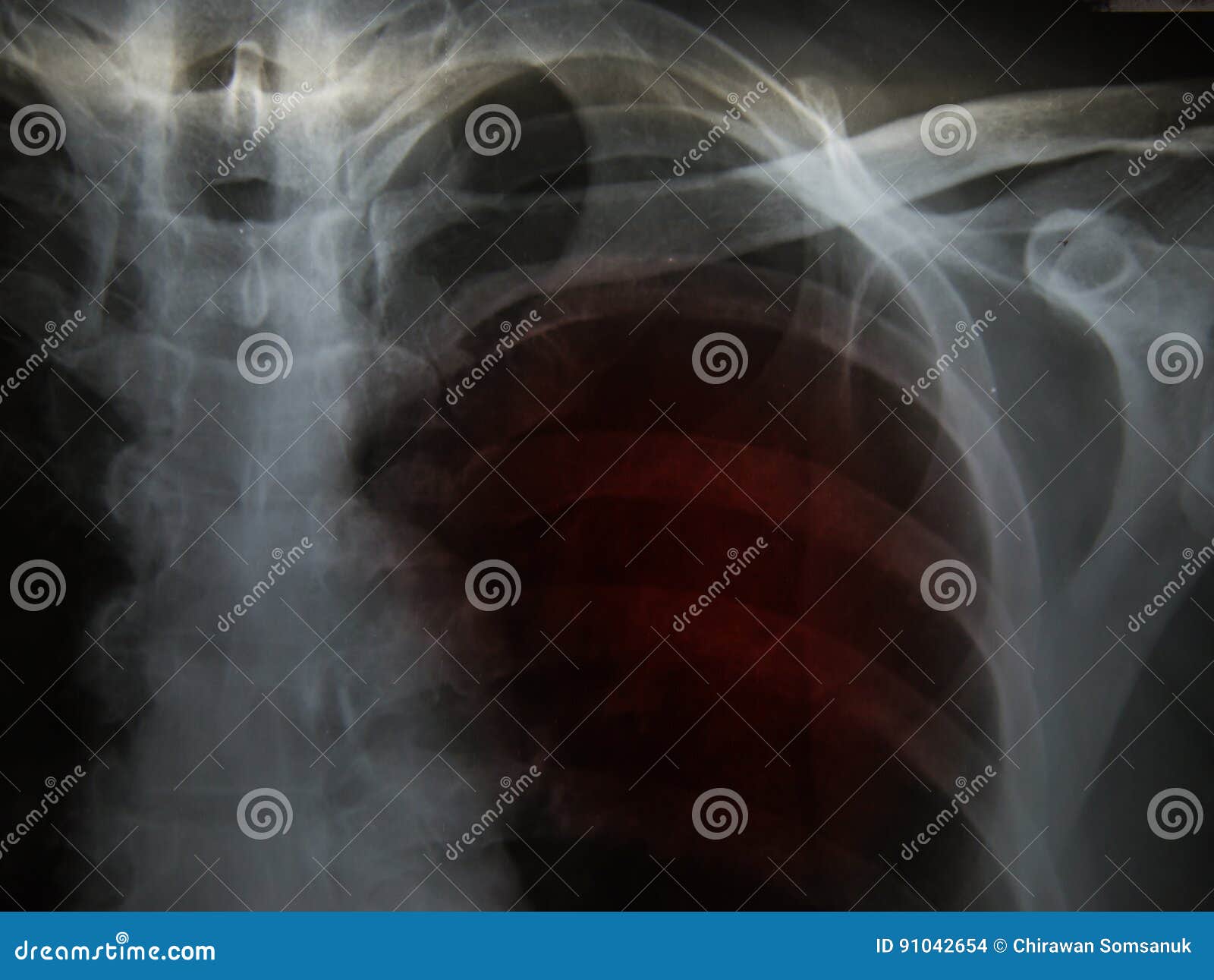 arm negative tb test arm negative tb test