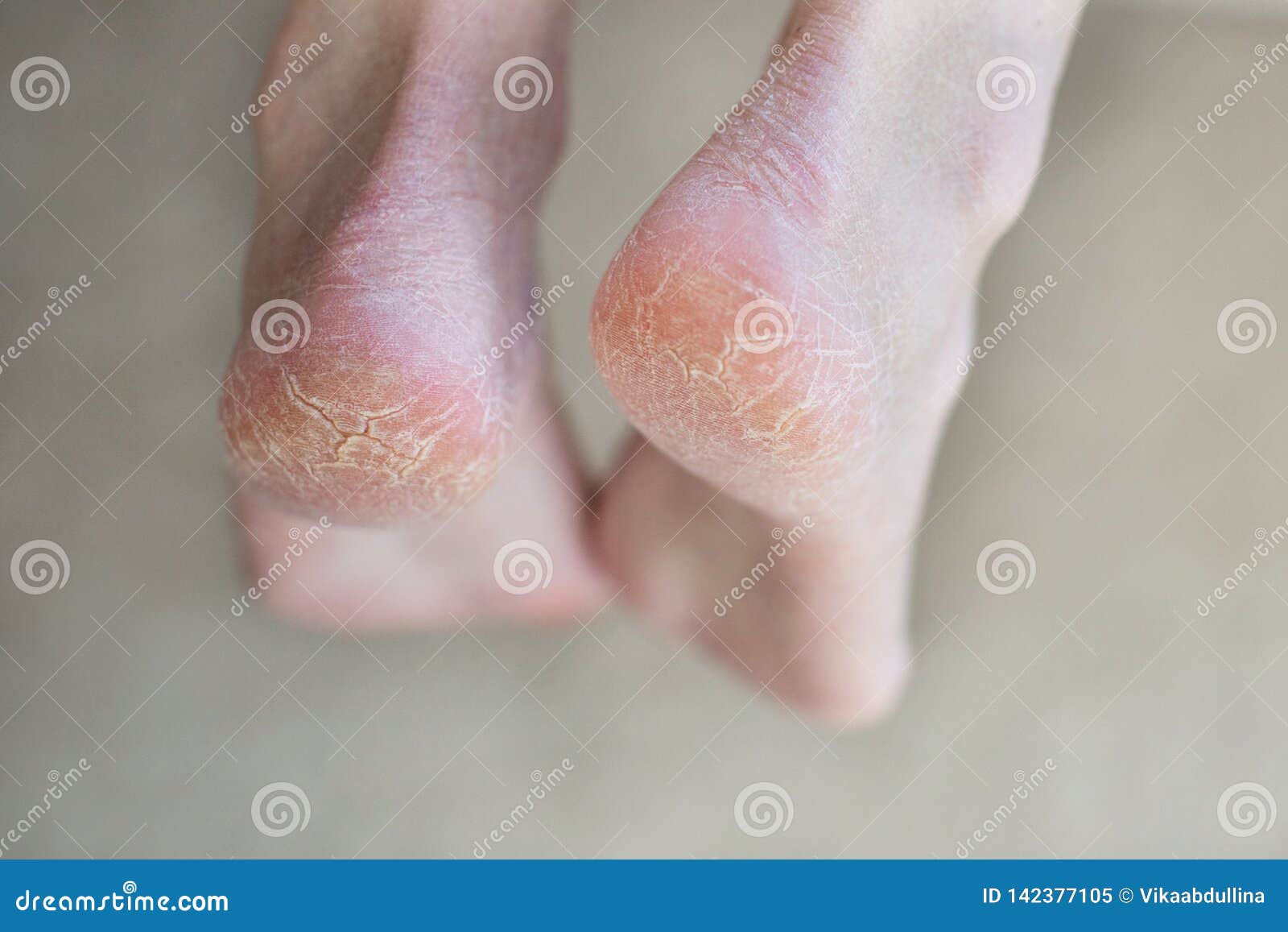 pointed heels hurt toes