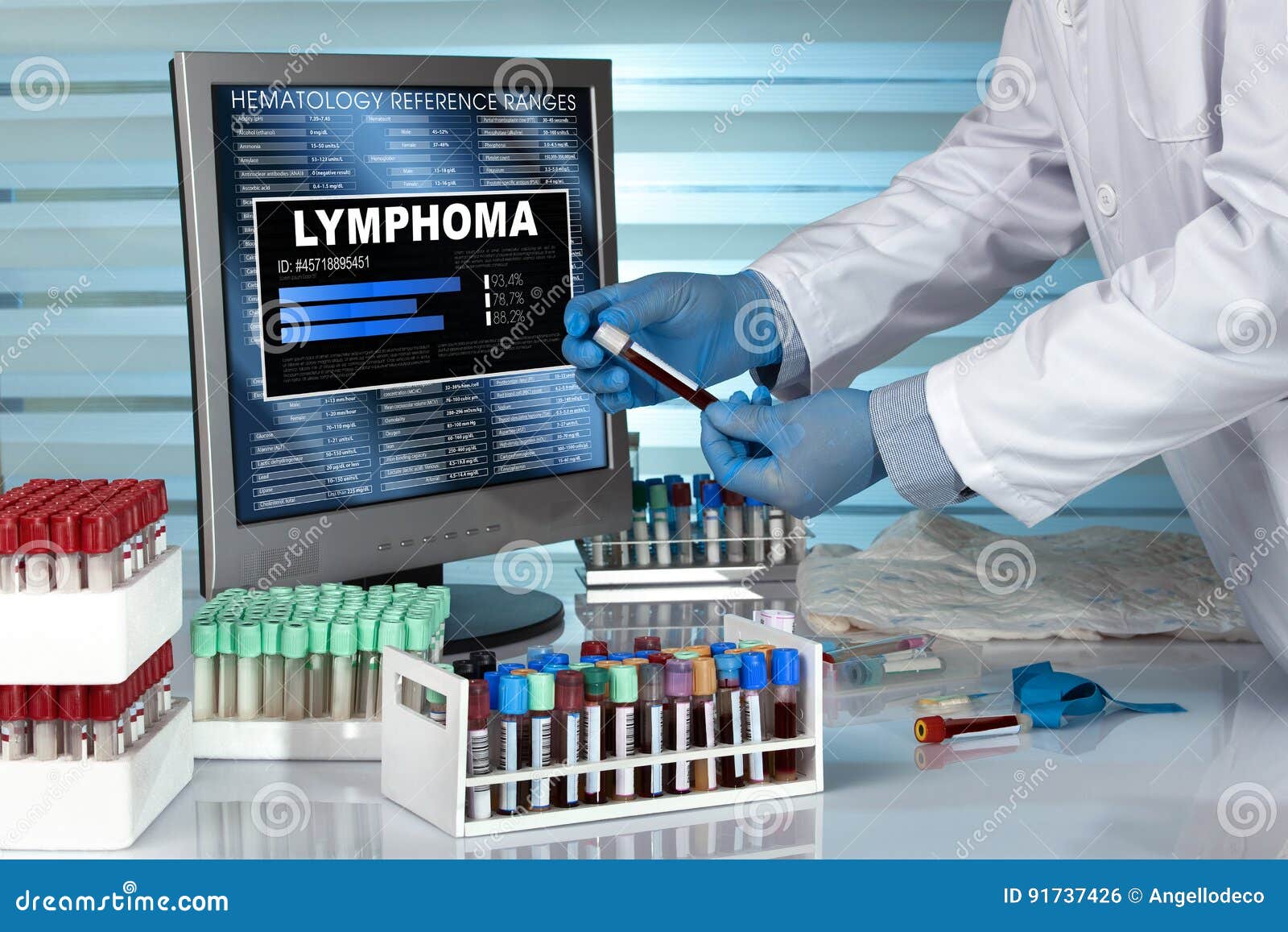 Technician in Lab Examining Blood Sample with Lymphoma Disease R Stock