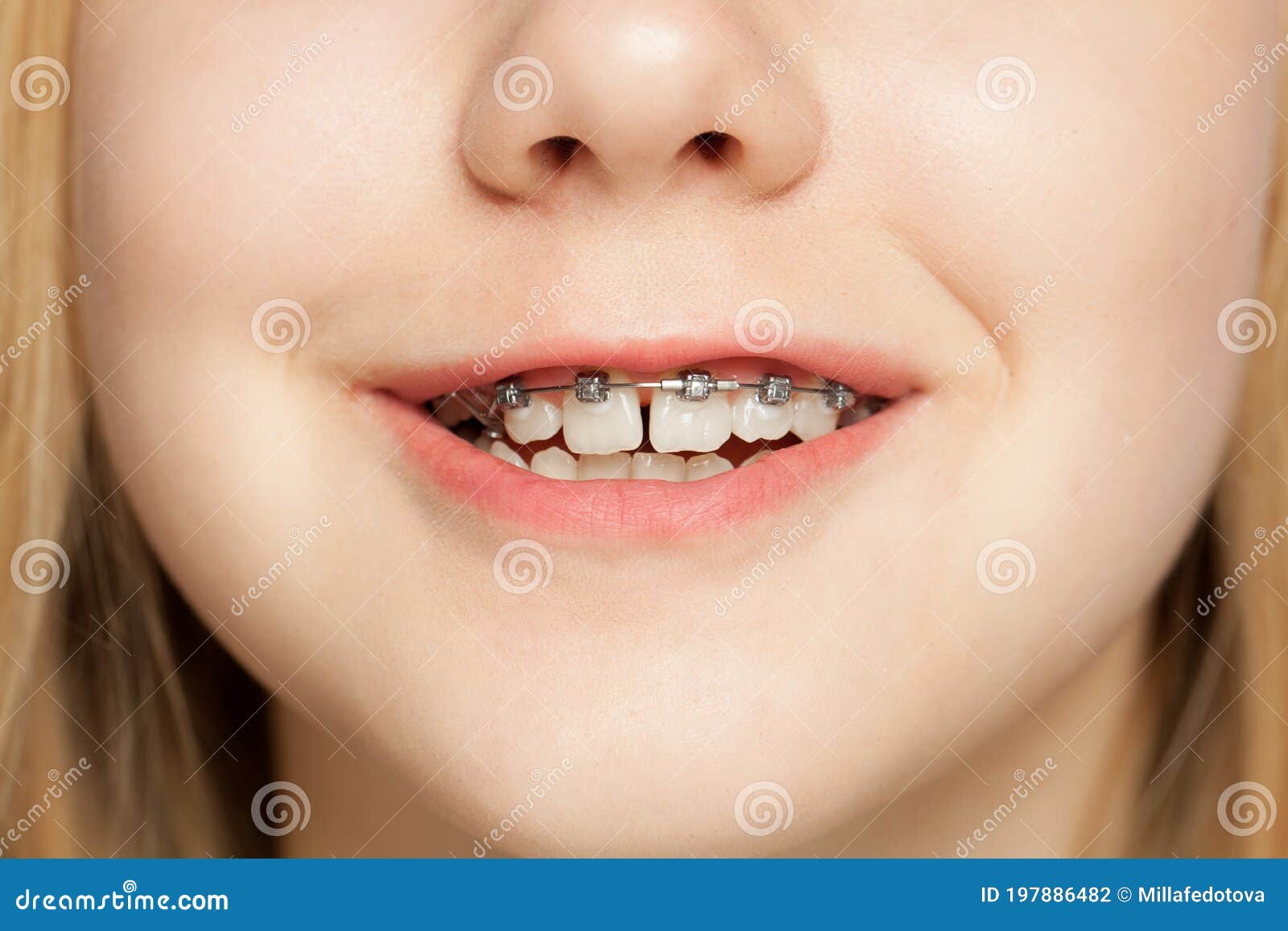 Young Girls With Braces On Teeth