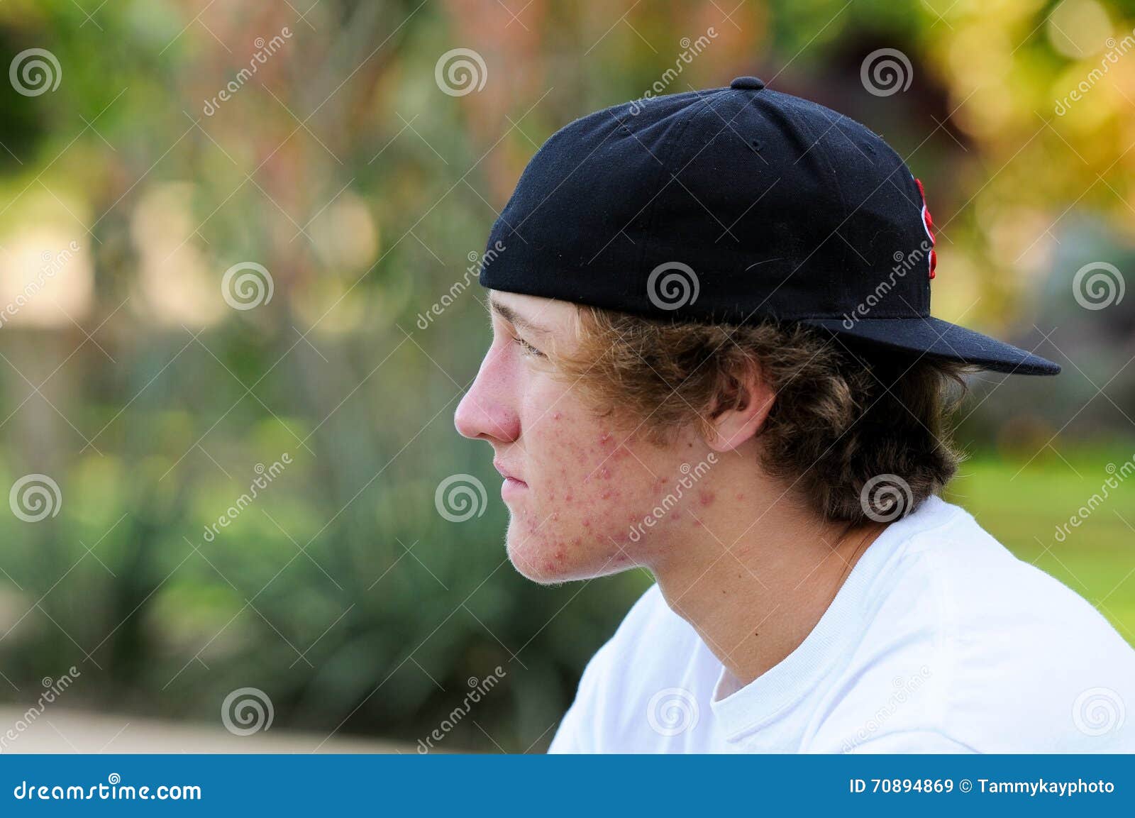 Teenage Boy With Acne And Backwards Baseball Hat Lo