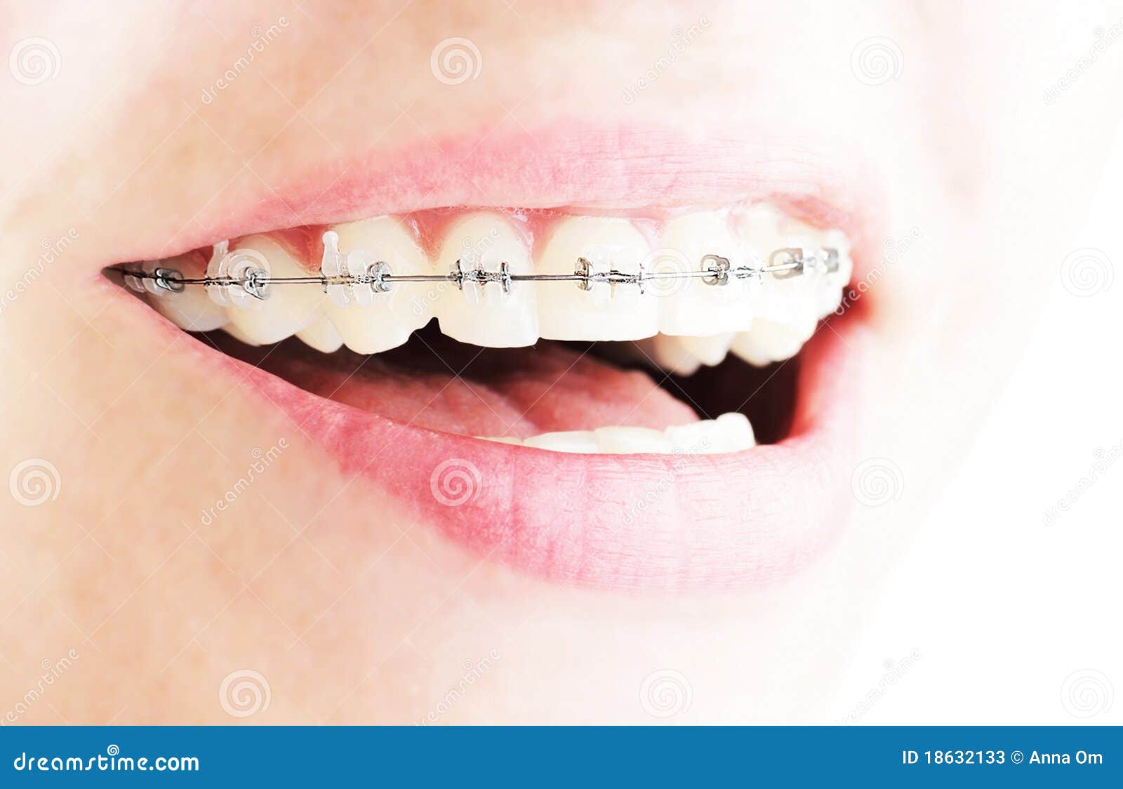 Teeth with braces, beautiful female smile, dental care concept