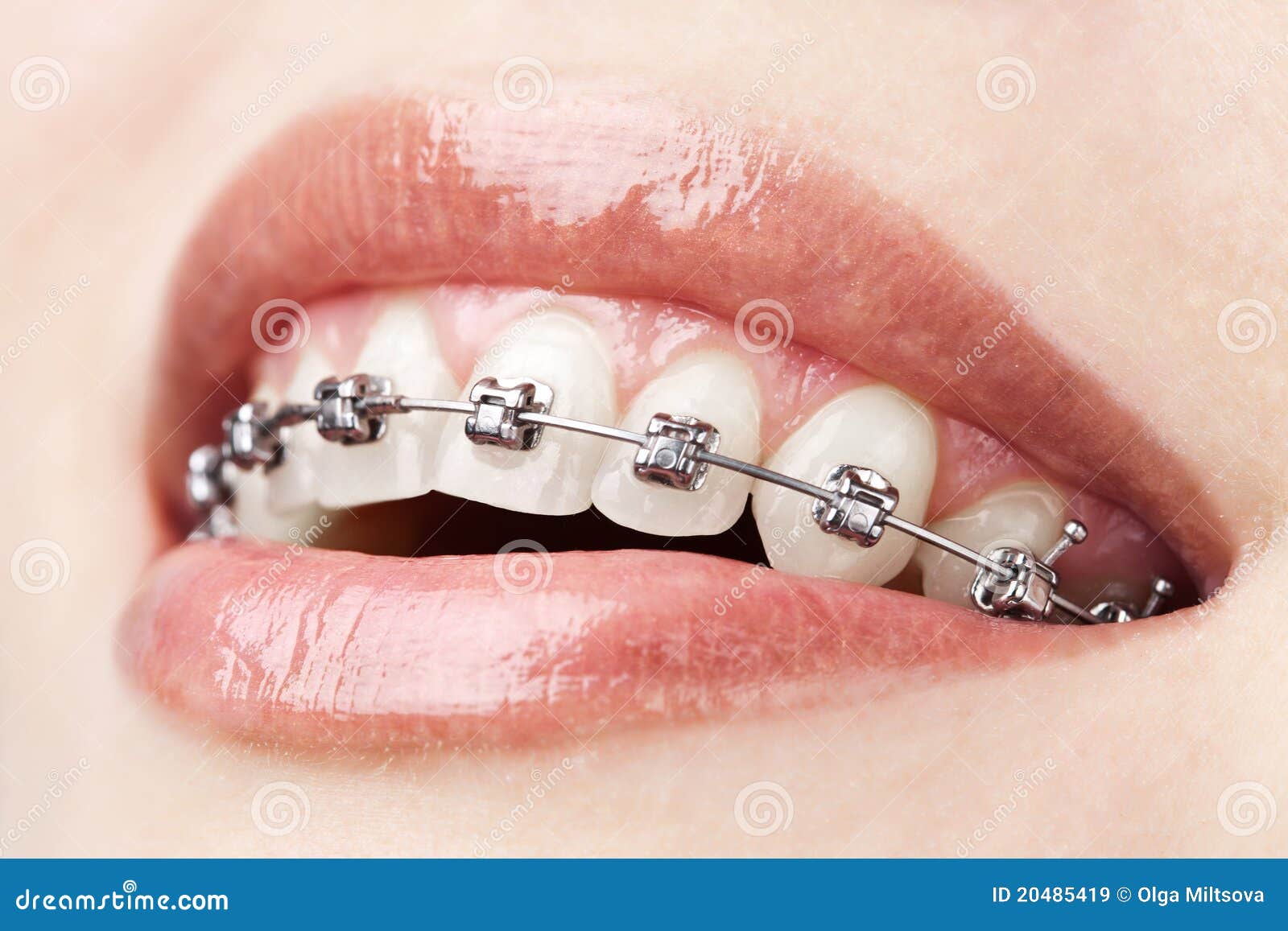 Teeth With Braces Royalty Free Stock Images - Image: 20485419