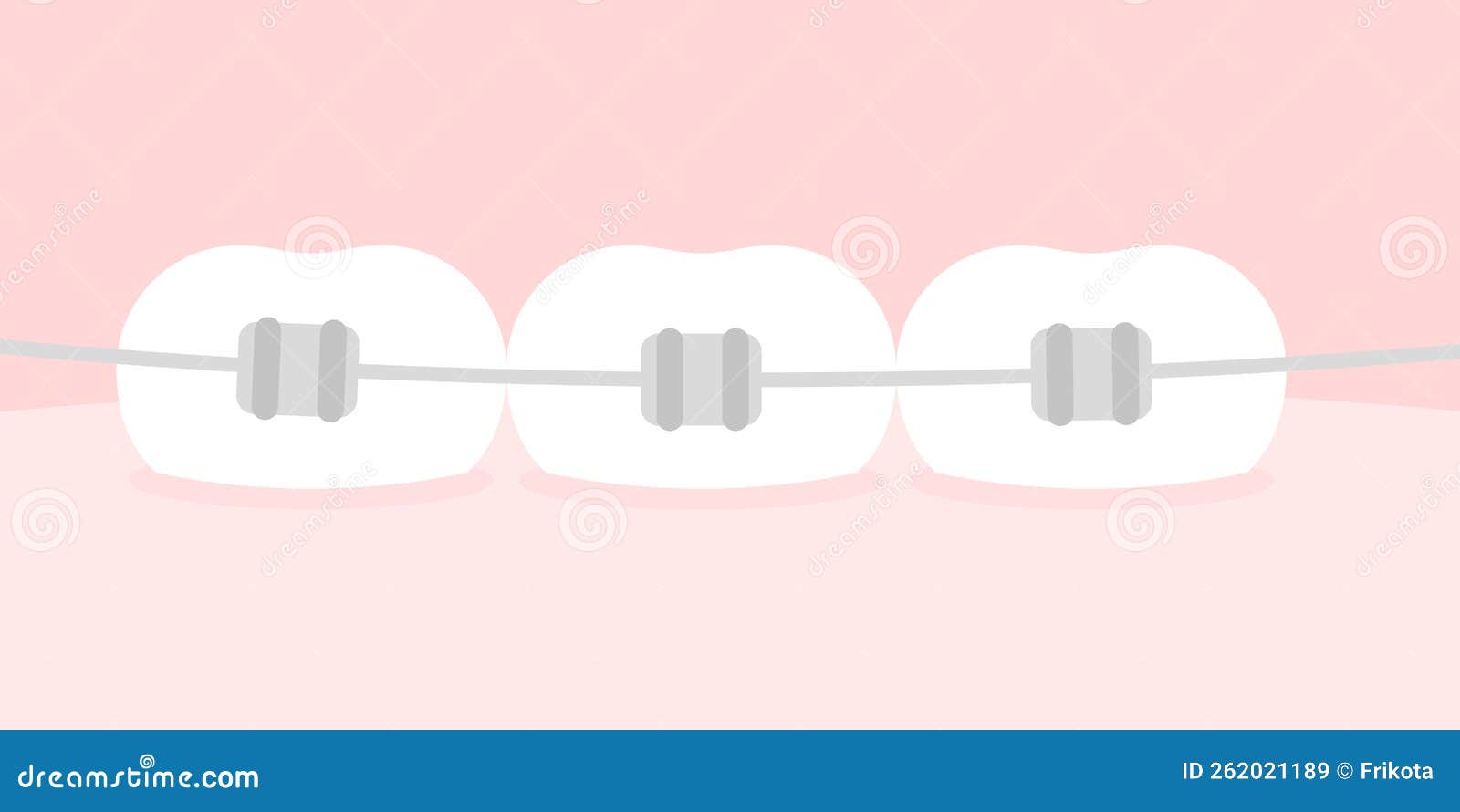 Teeth Braces. Concept of Orthodontics. Horizontal Format. Vector