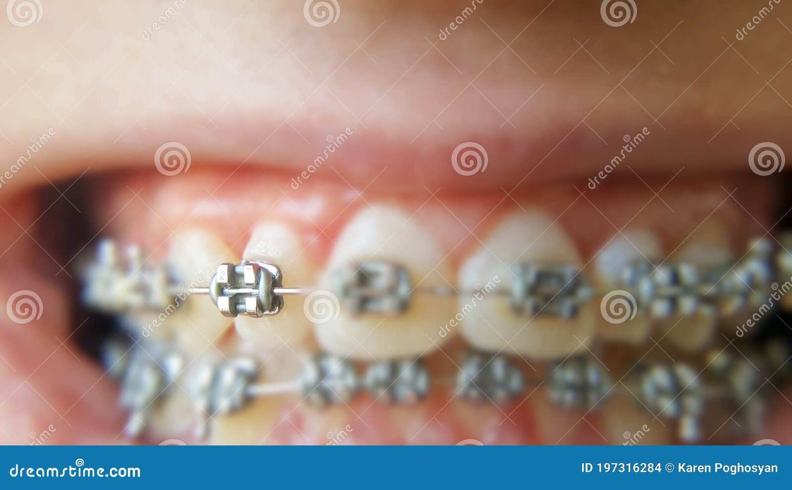 teeth with braces or braces in an open human mouth. selective focus on one bracket. dental care. straightened teeth