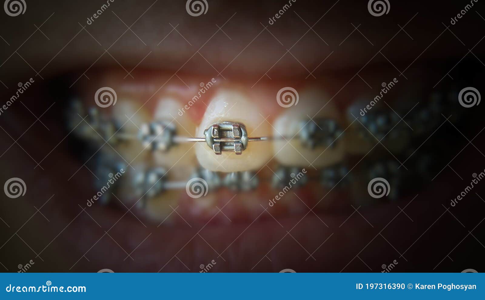 teeth with braces or braces in an open human mouth. selective focus on one bracket. dental care. straightened teeth