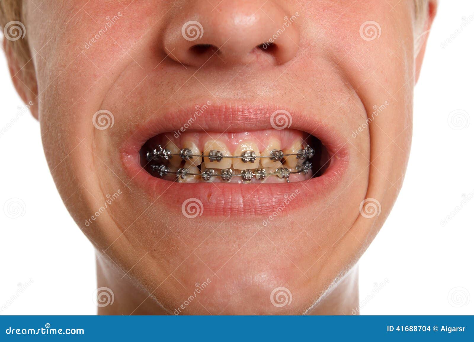 Teeth braces stock photo. Image of silver, health, orthodontic 41688704