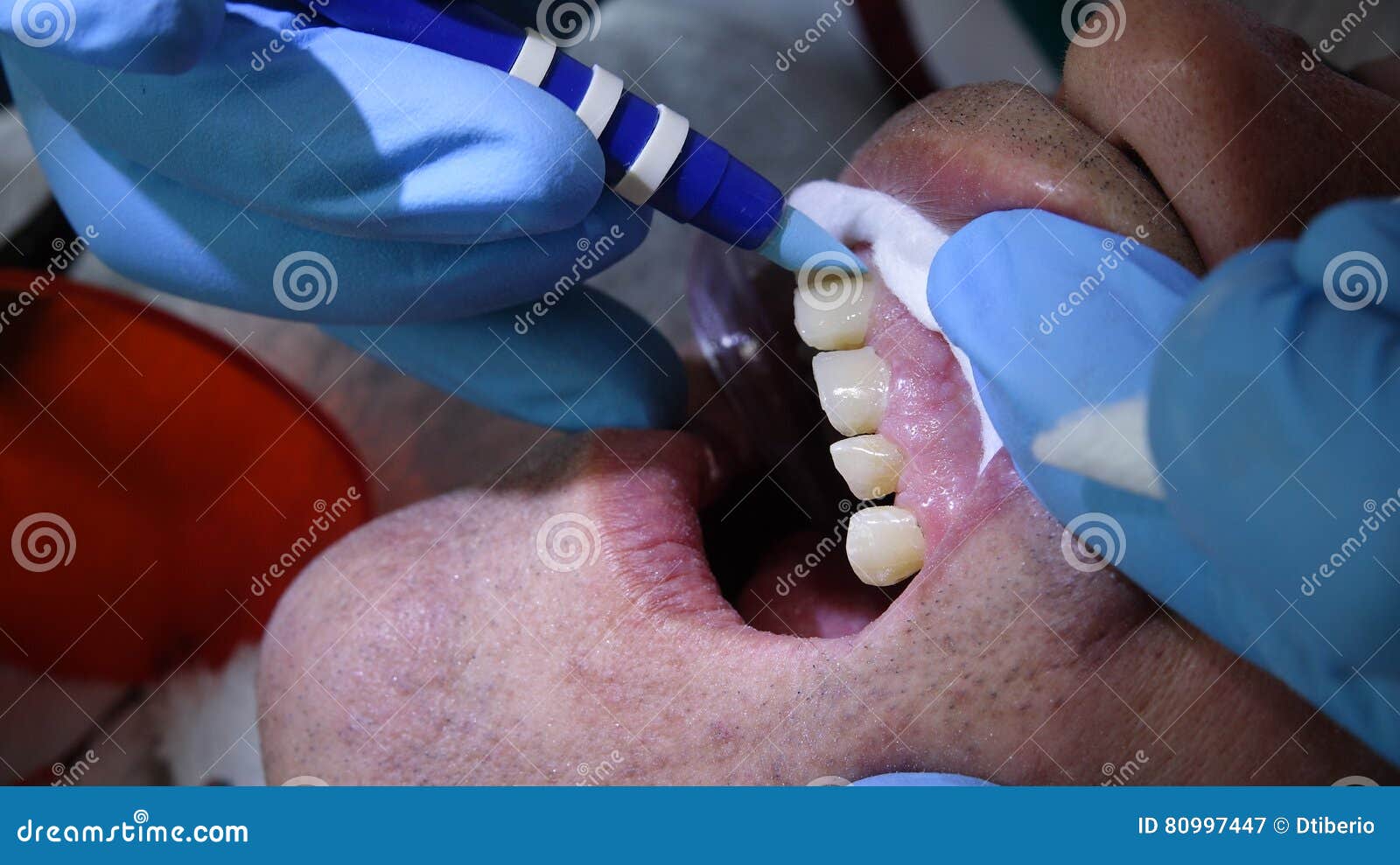 Teeth Cleaning and Dentistry Stock Image Image of dentistry, dental 80997447