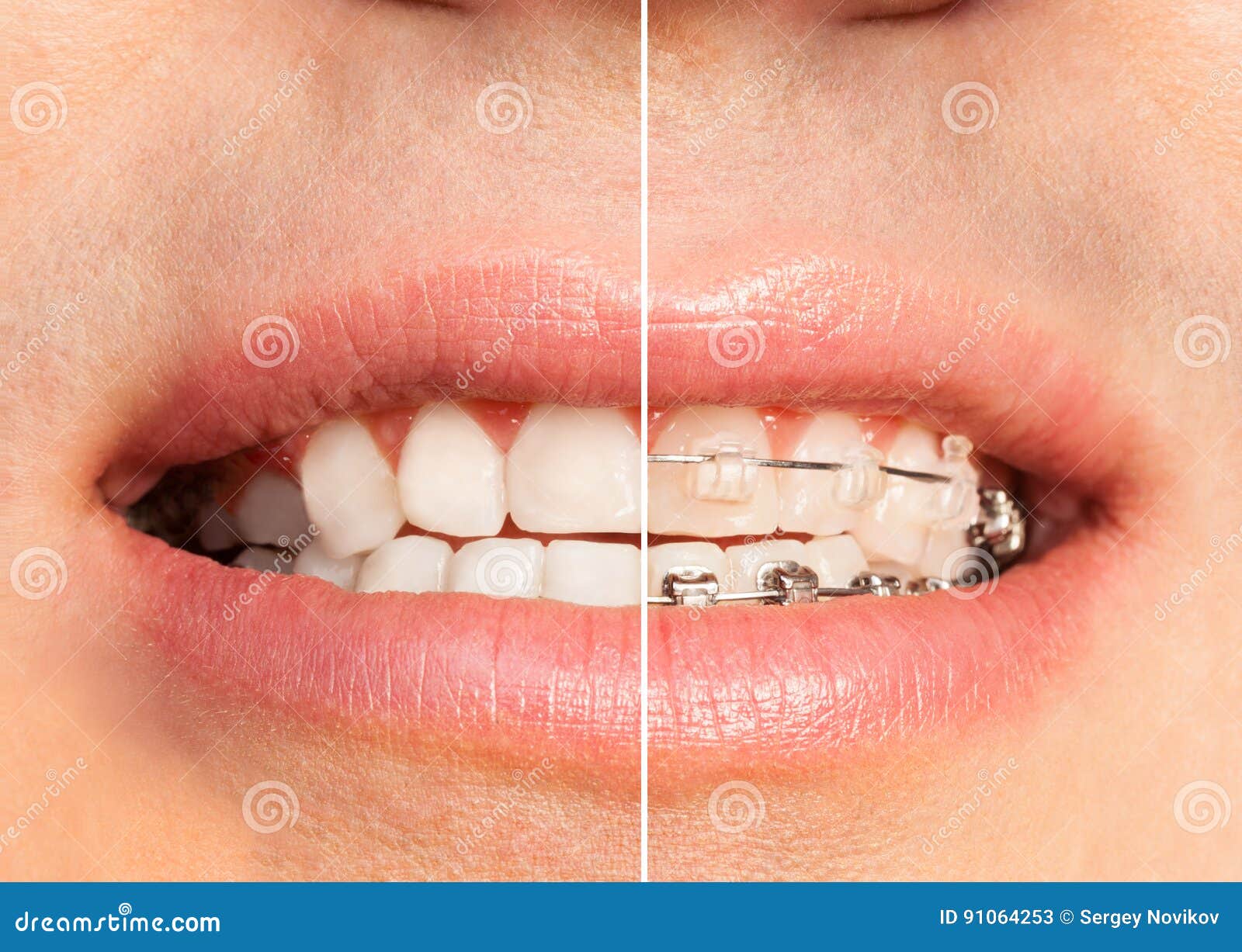 Teeth with and without Dental Braces Full Mouth Stock Image Image of