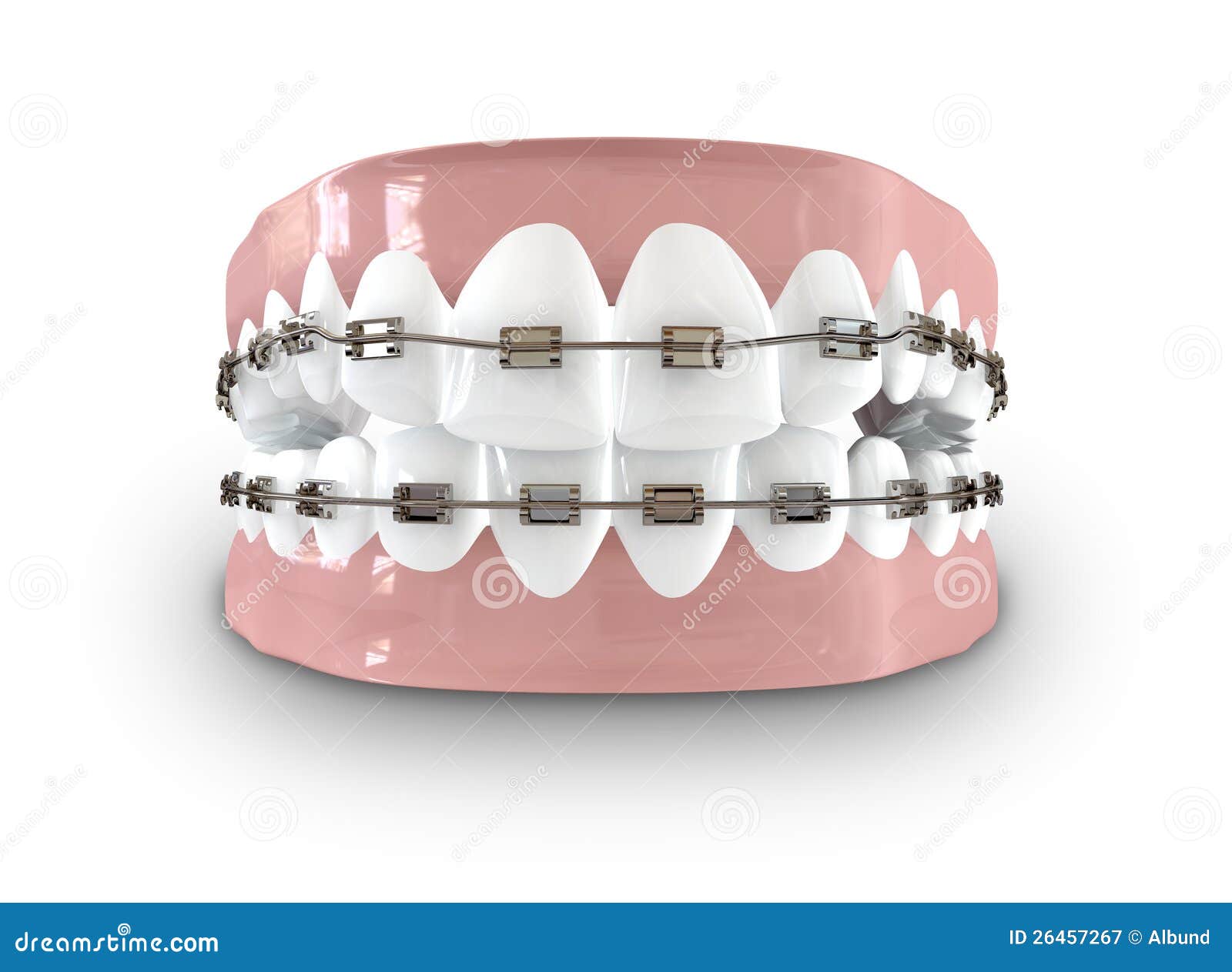 Teeth Fitted with Braces stock illustration. Illustration of health 26457267