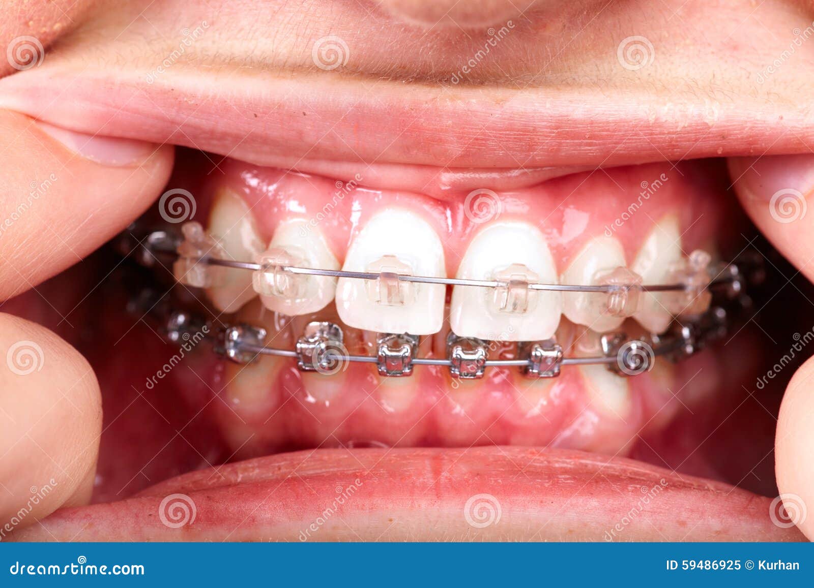 teeth with orthodontic brackets.