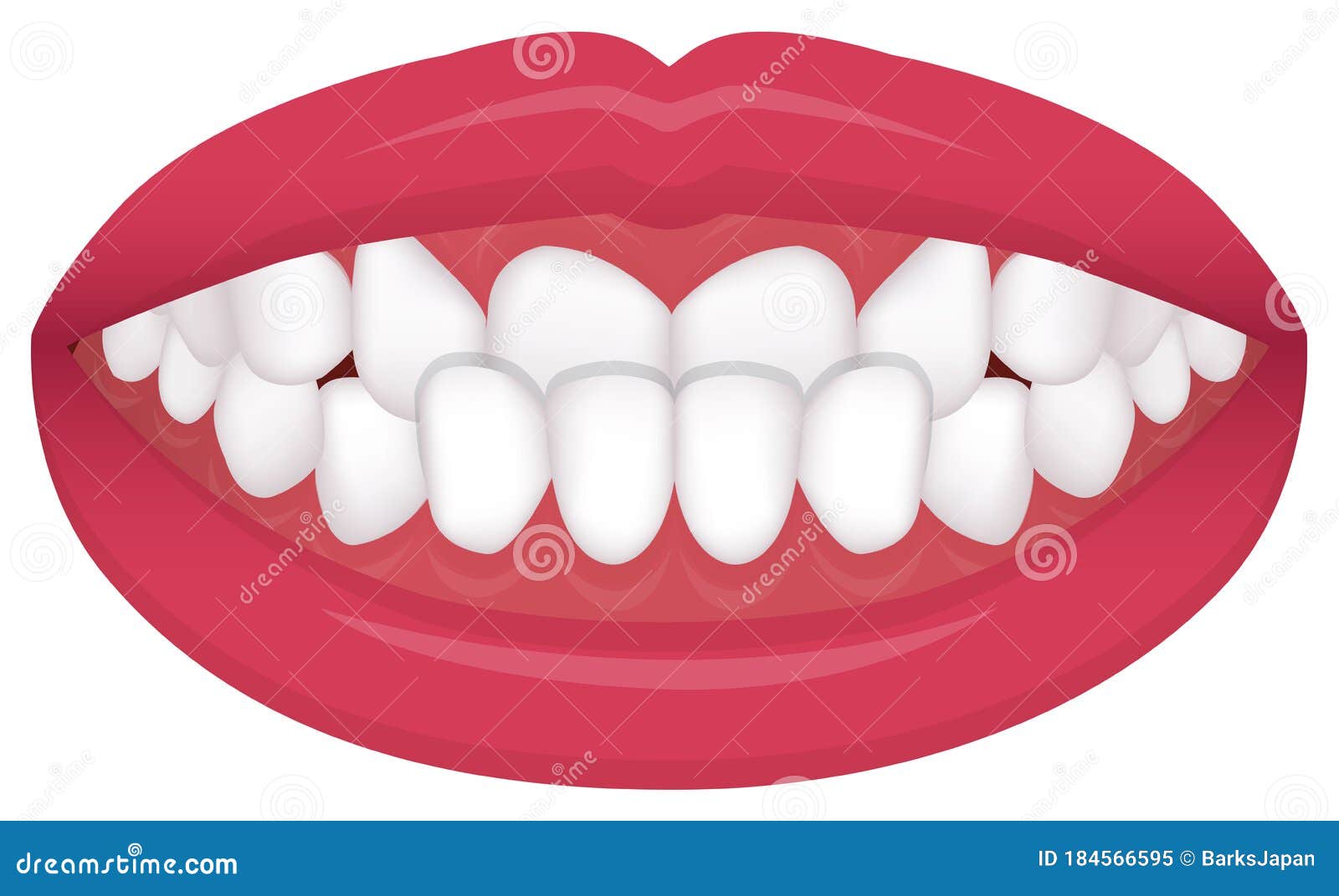 Teeth Trouble Bite Type Vector Illustration / Crossbite Misalignment