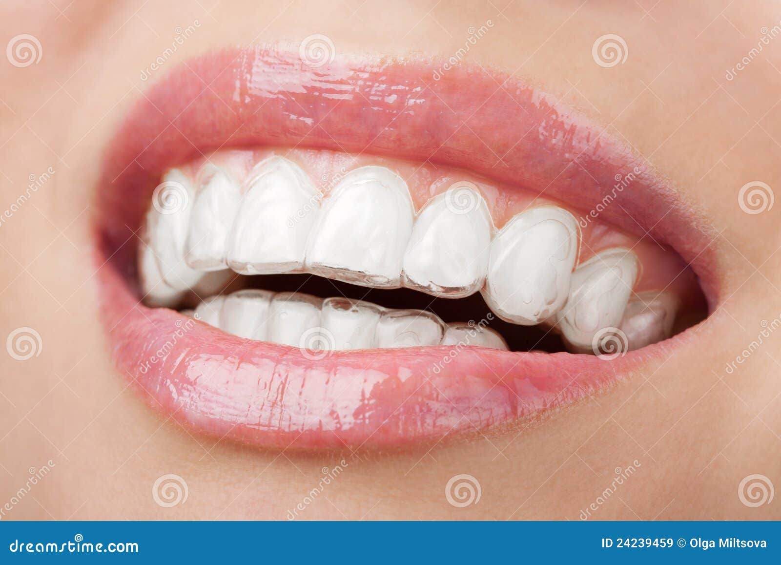 teeth with whitening tray