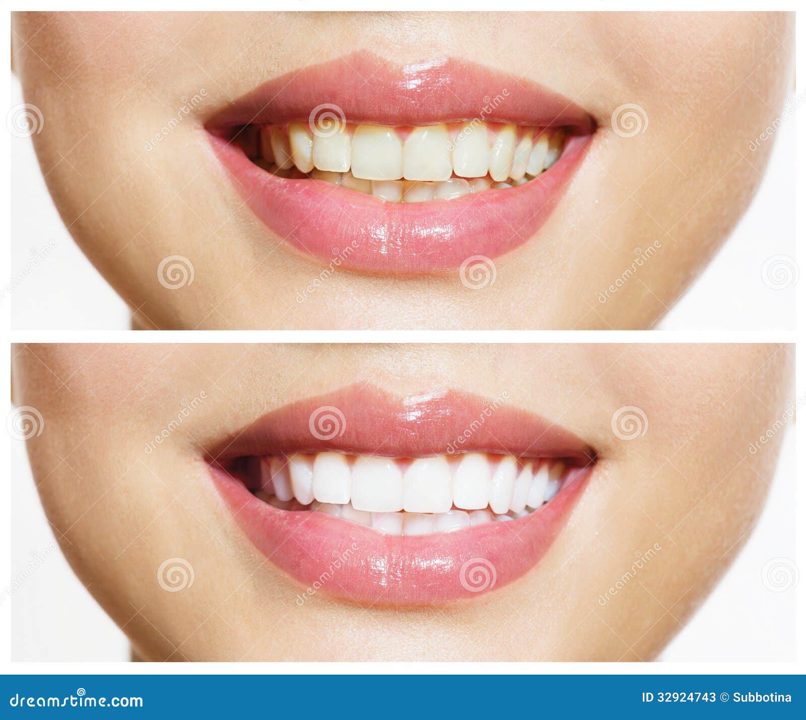 teeth before and after whitening