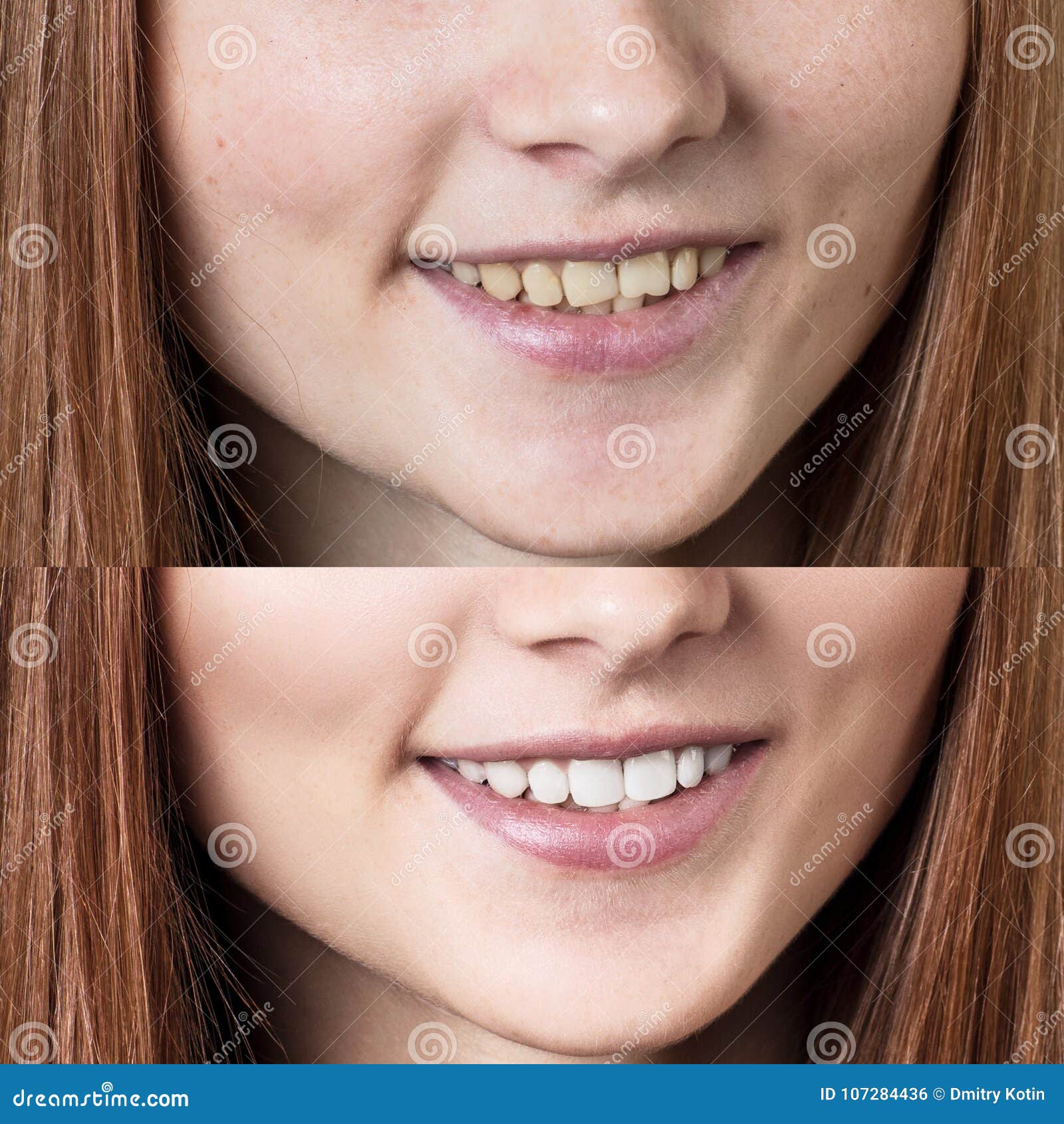 Teeth of Young Woman before and after Whitening. Stock Photo Image of