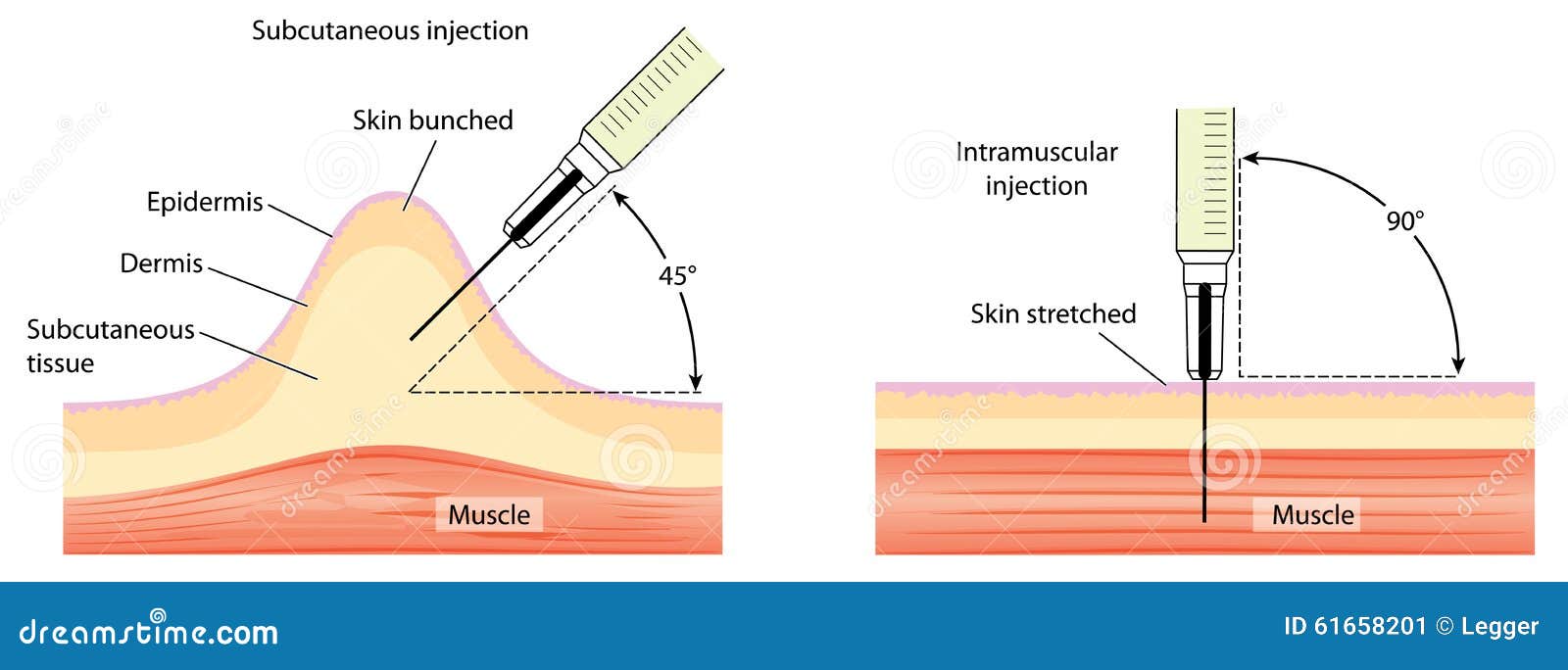 Tekniker För Subkutan Och Intramuscular Injektion Vektor Illustrationer ...