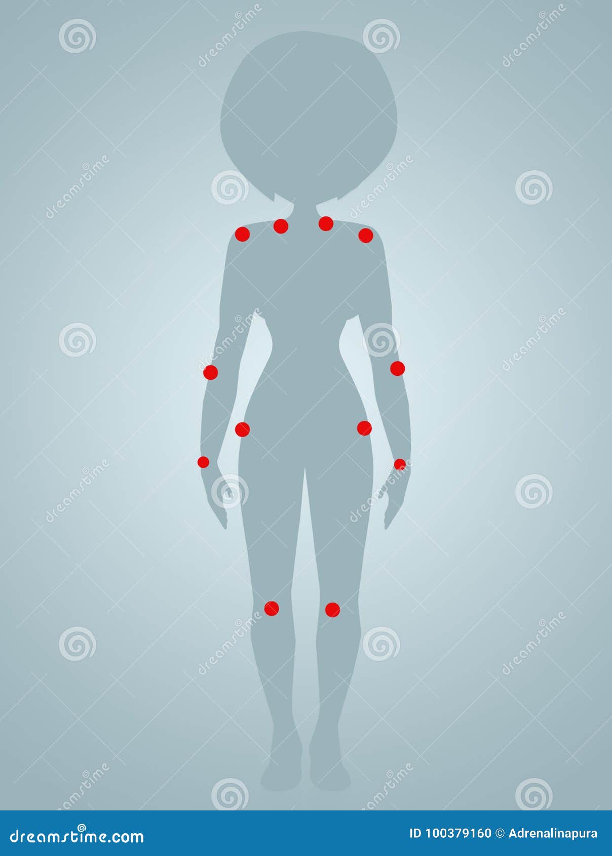 Tender Points Of Fibromyalgia With Pain Location On Body Outline