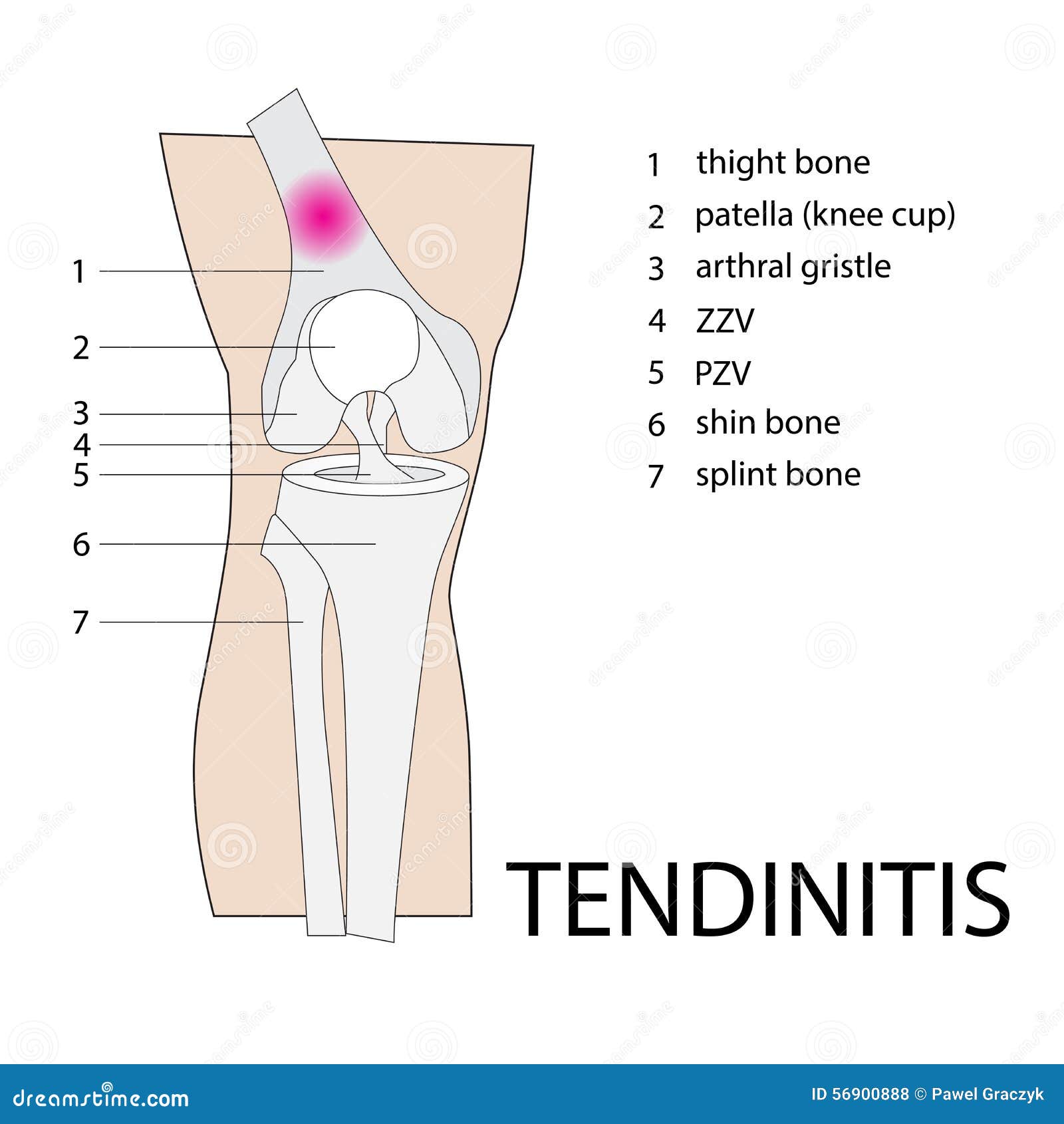 Tendinitis Knee Injury Stock Vector Illustration Of Healthy 56900888 tendinitis-knee-injury-stock-vector-illustration-of-healthy-56900888