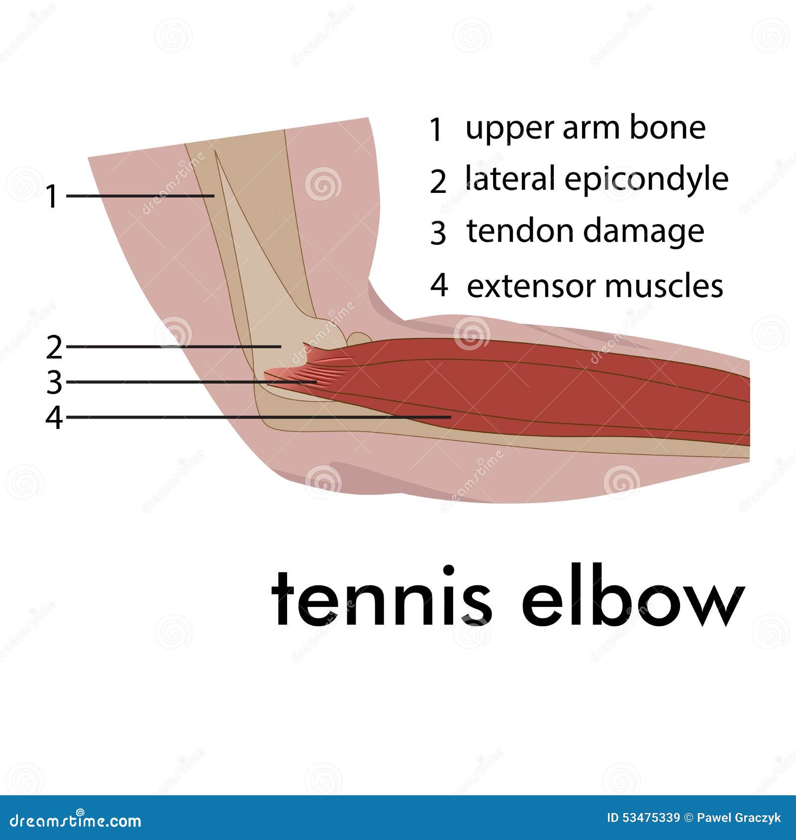 Tennis elbow illustration de vecteur. Illustration du vecteur 53475339