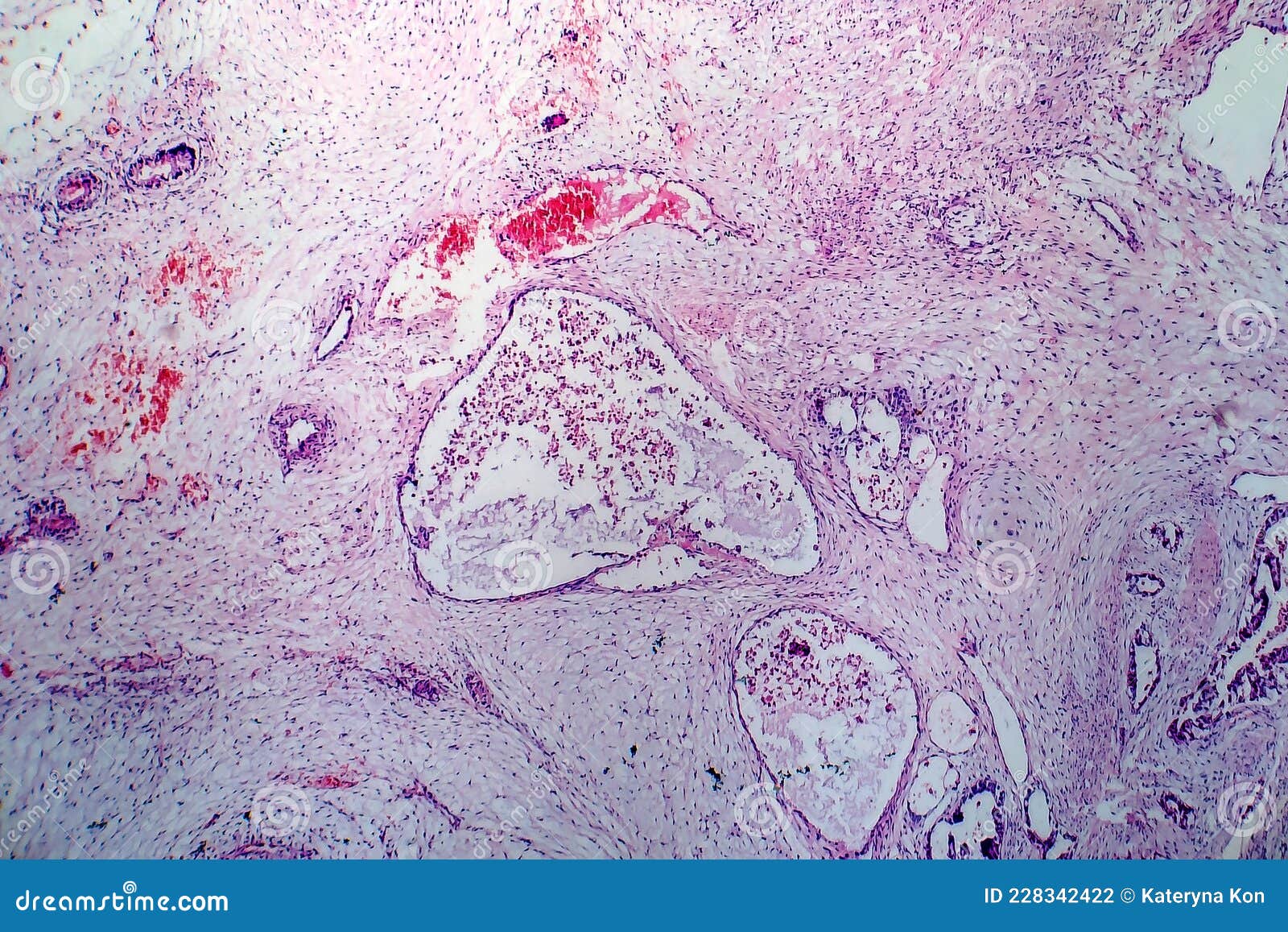 Teratoma, light micrograph stock photo. Image of beauty - 228342422 Teratoma, light micrograph stock photo. Image of beauty - 228342422