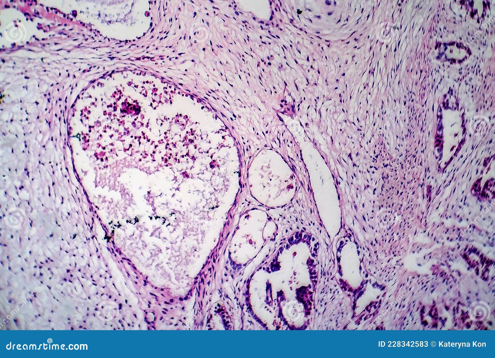 Teratoma, light micrograph stock image. Image of medical - 228342583 Teratoma, light micrograph stock image. Image of medical - 228342583