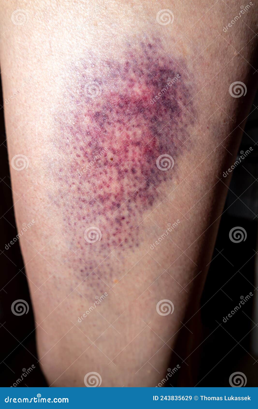 Terrible Bruise on the Upper Leg of a Woman Stock Image Image of