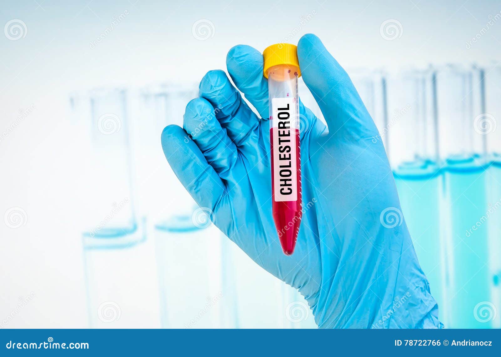 Testtube with Blood Sample for CHOLESTEROL Test Stock Photo Image of