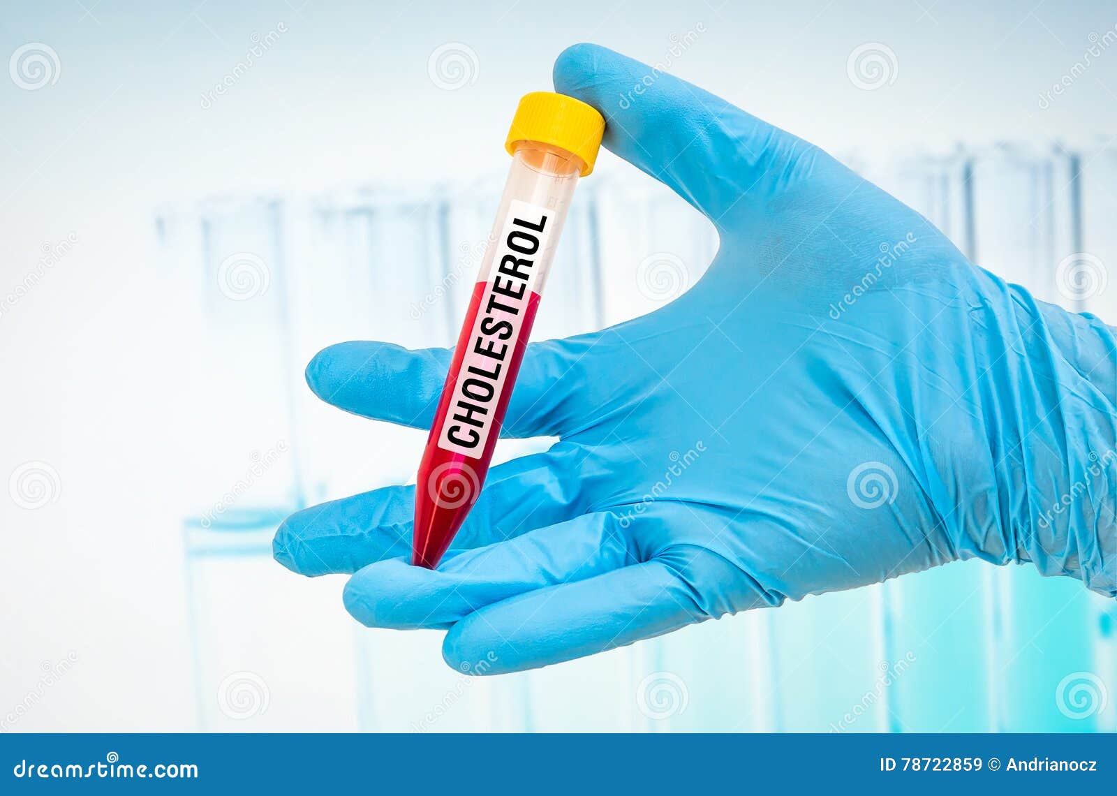 Testtube with Blood Sample for CHOLESTEROL Test Stock Image Image of