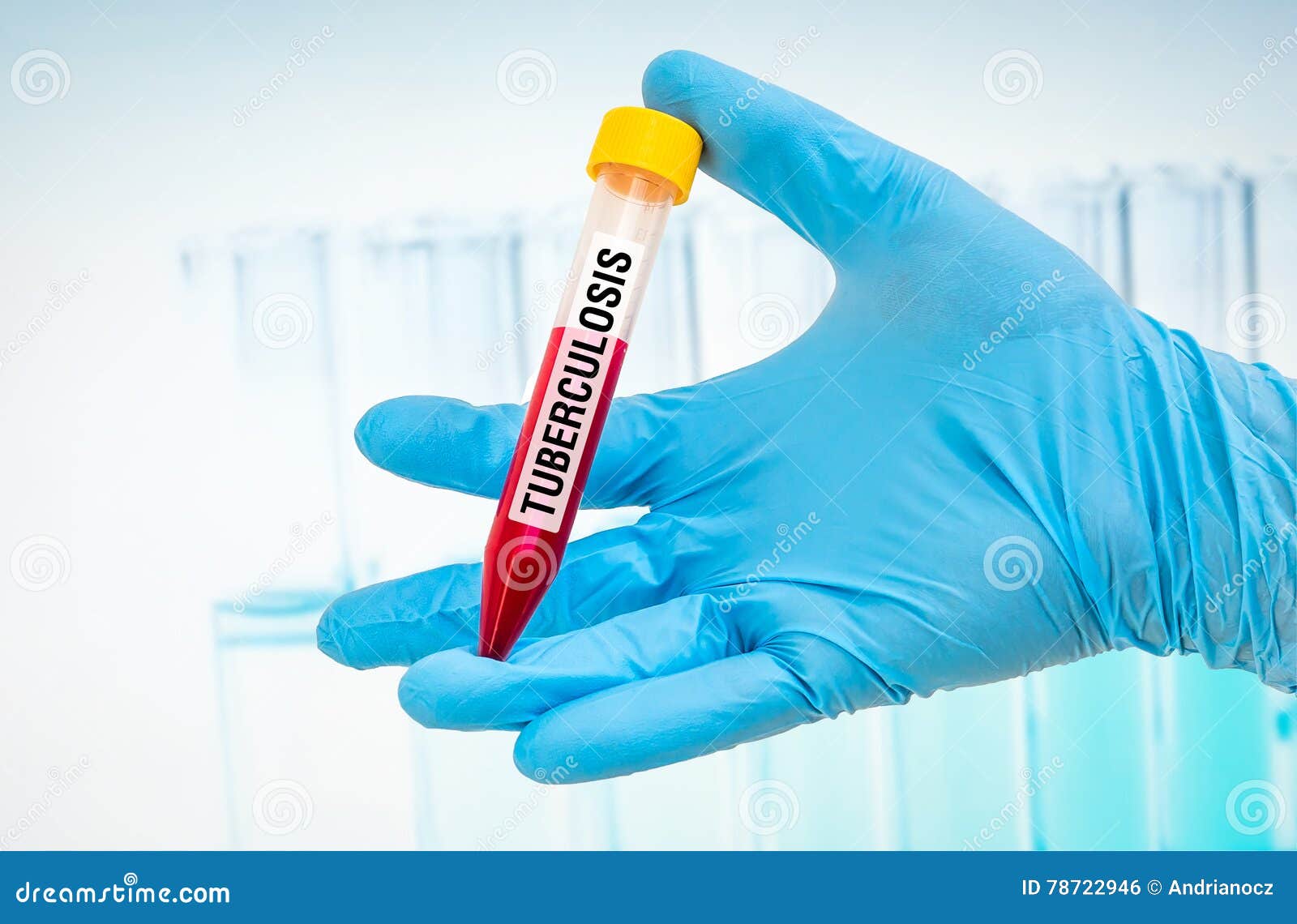 Testtube with Blood Sample for TUBERCULOSIS Test Stock Photo Image