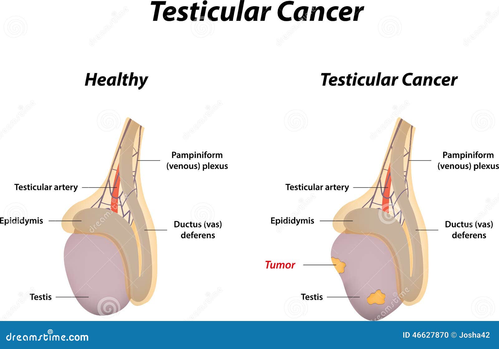 testicular cancer 