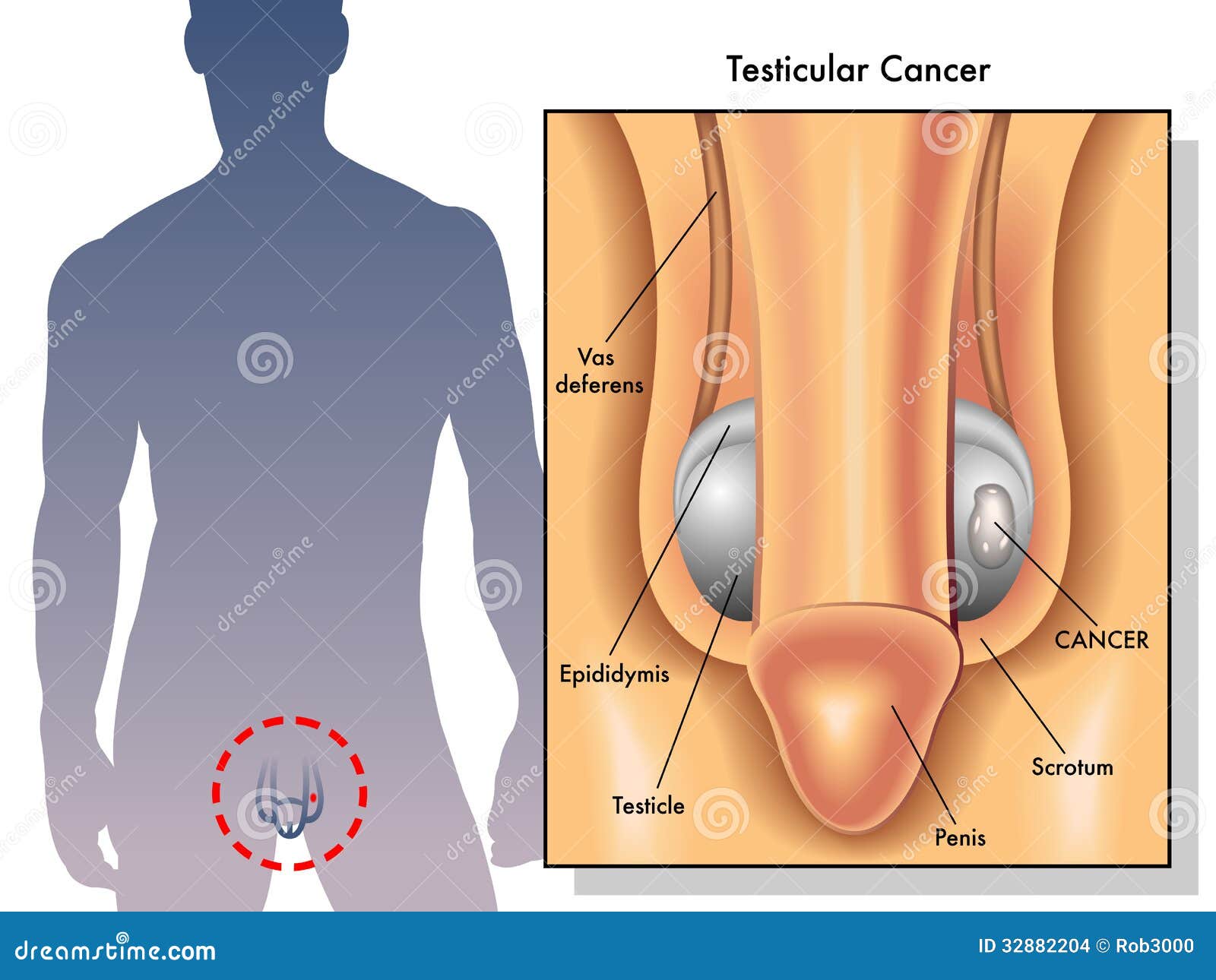 testicular cancer 