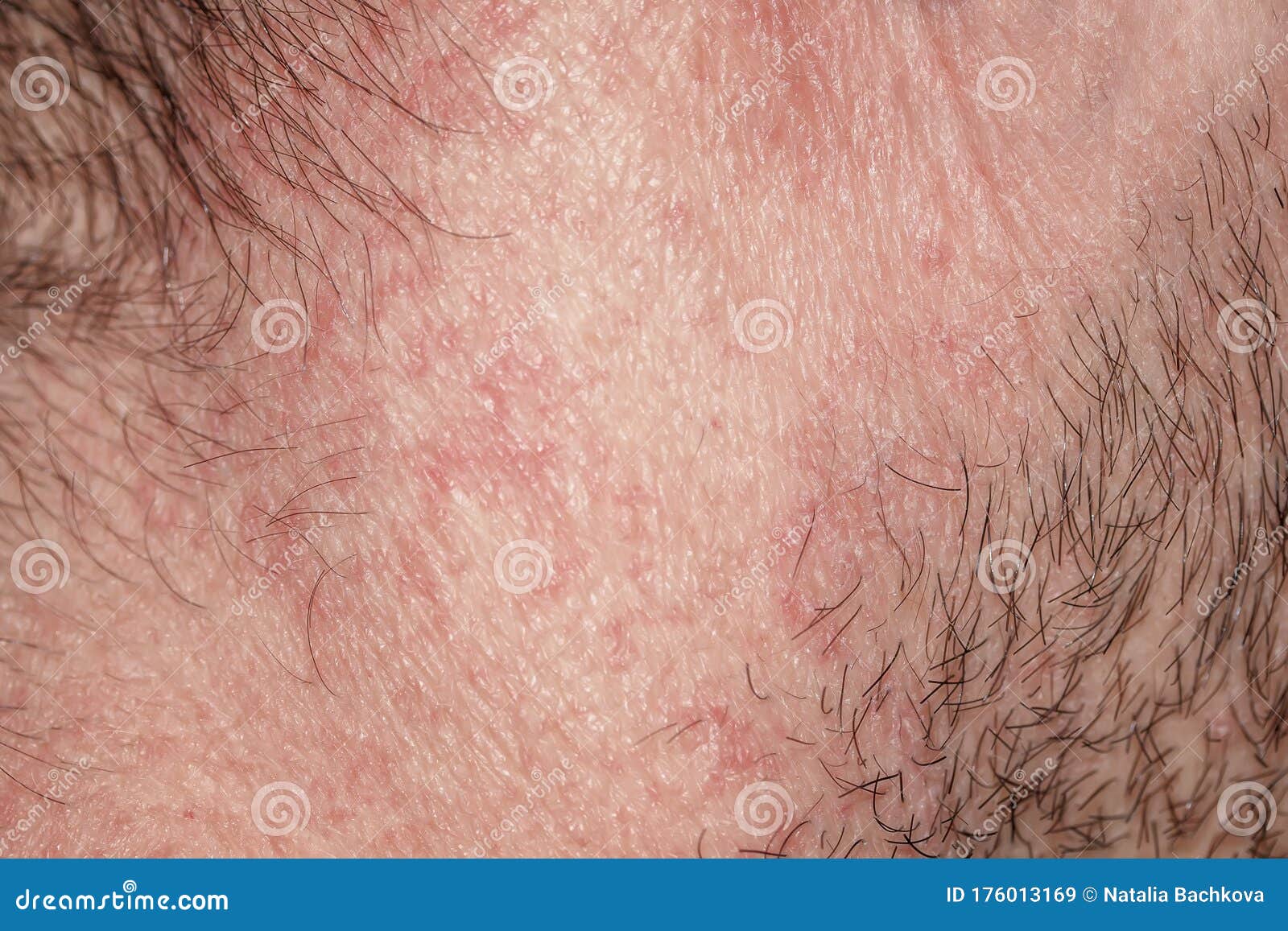 Irritated Reddened Male Neck Skin Covered with Hair and Bristles Stock