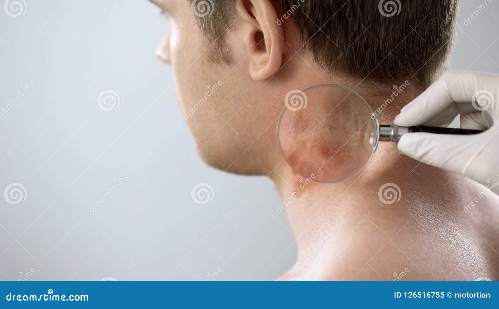 therapist examines rash on patient neck with magnifying glass, dermatology