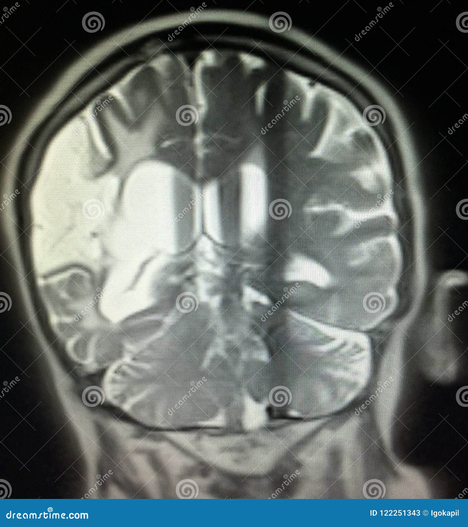 Acute Infarction Brain Mri Examination Stroke Stock Image - Image of ...