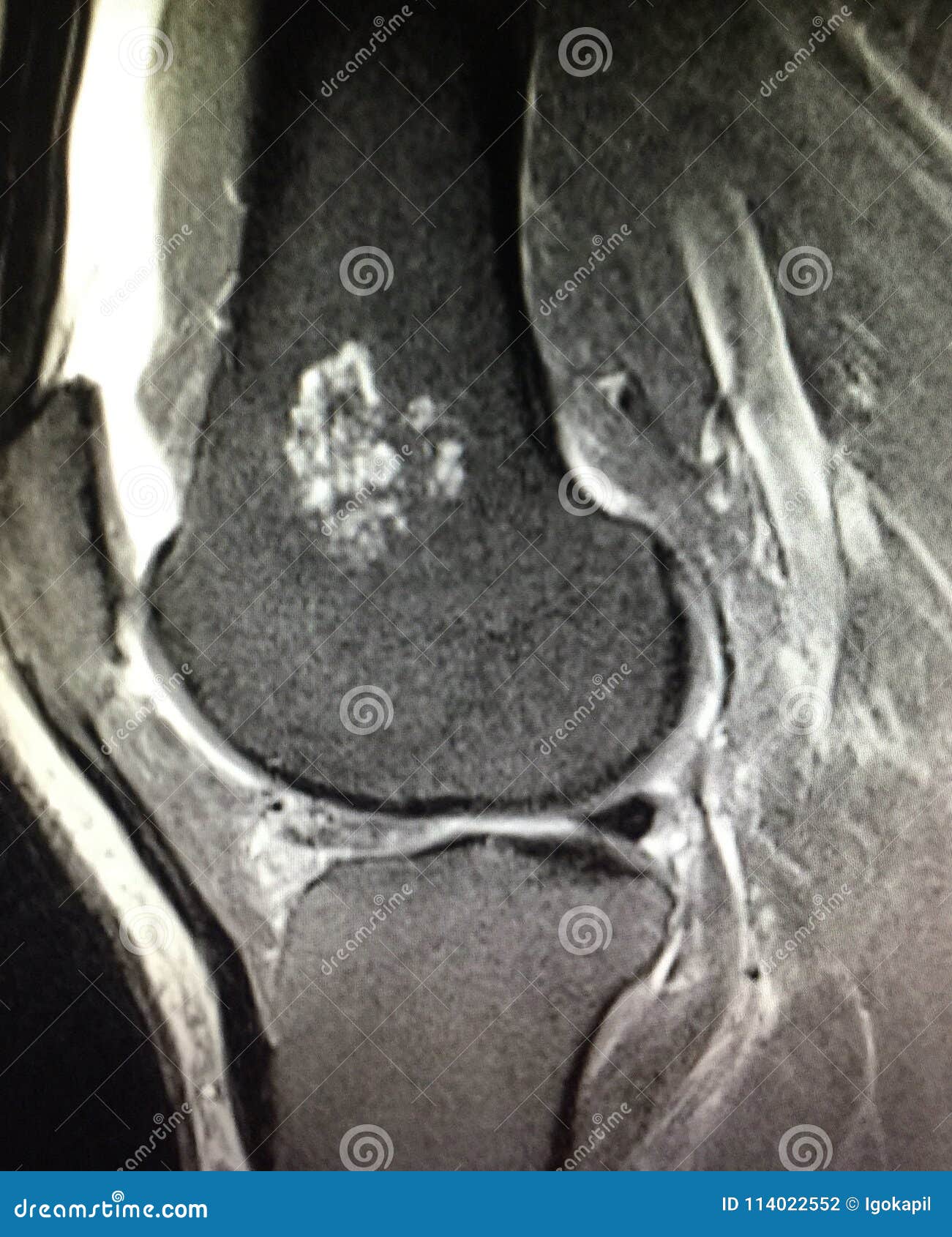 Knee Pathology Chondroid Lesion Enchondroma Mri Stock Photo - Image of ...