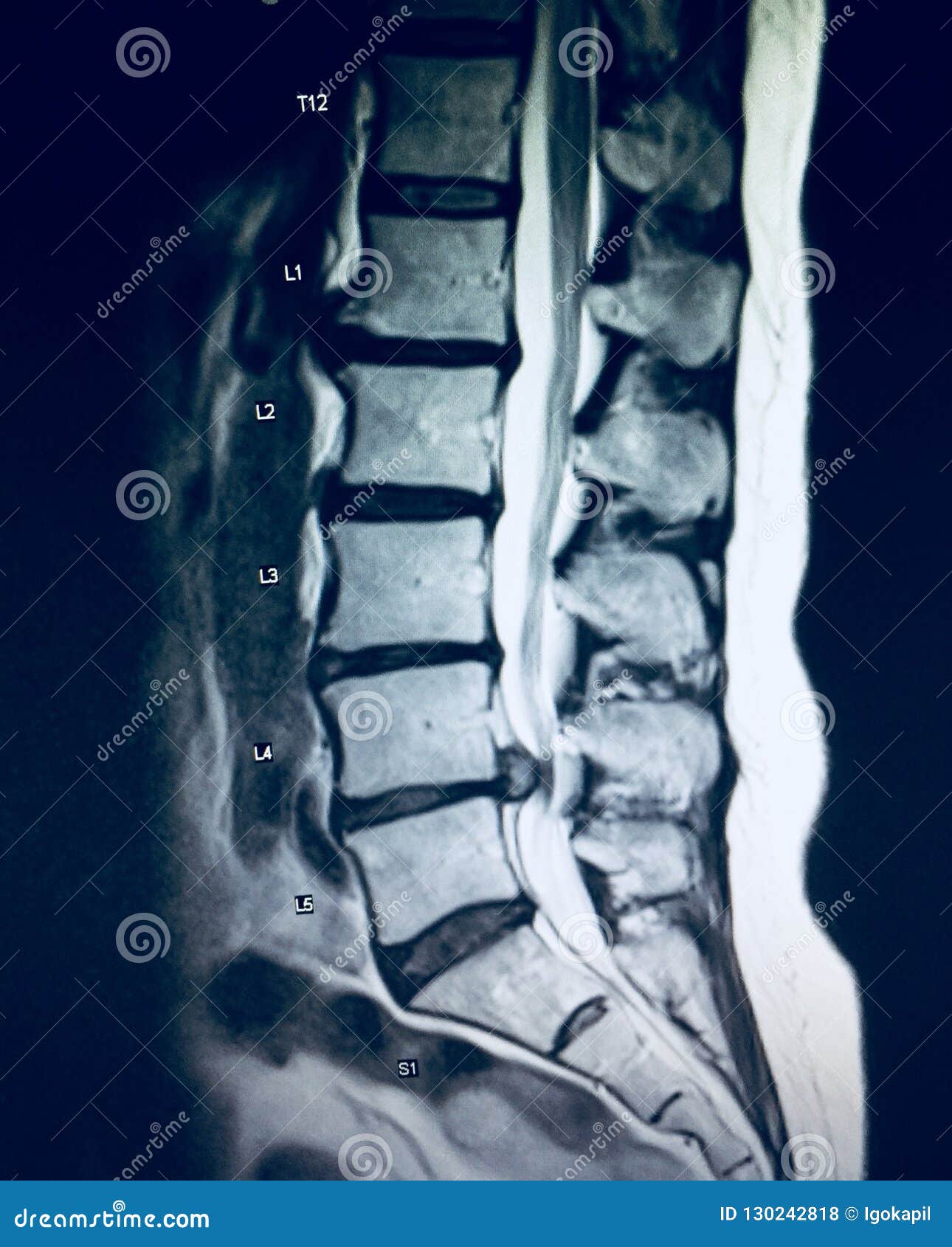 severe pathology of lumbar spine herniation mri