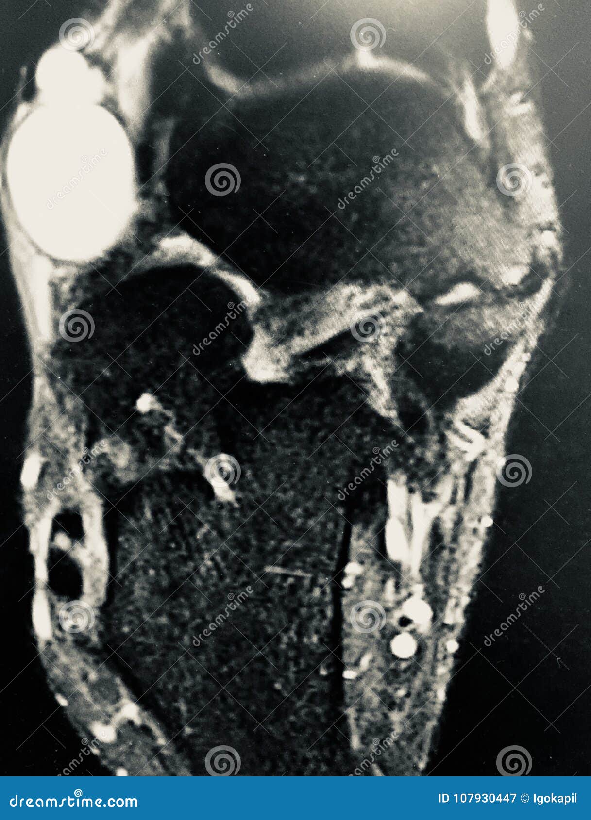 right foot dorsal aspect mass mri exam